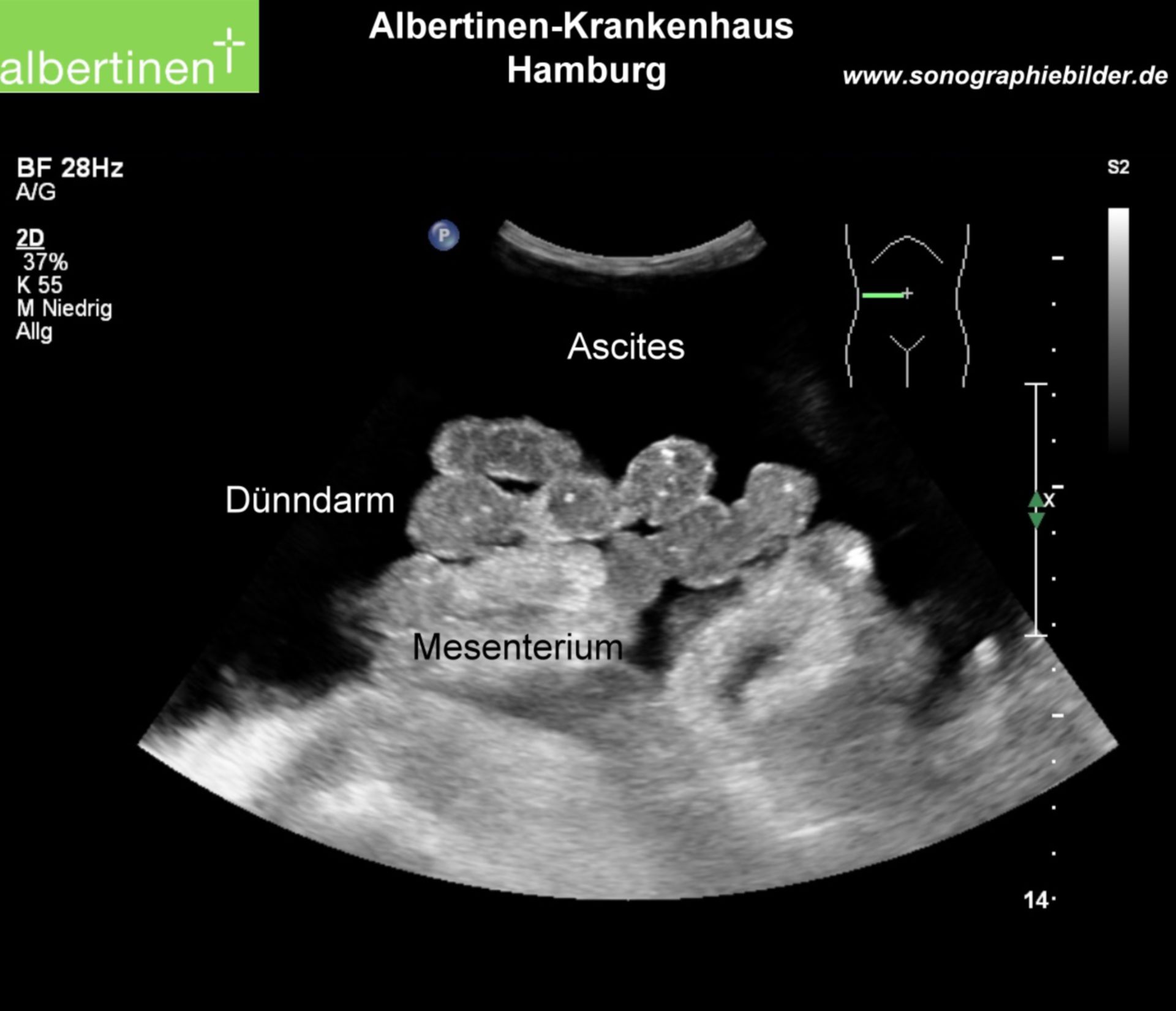 Ascites Dünndarm Sono Text