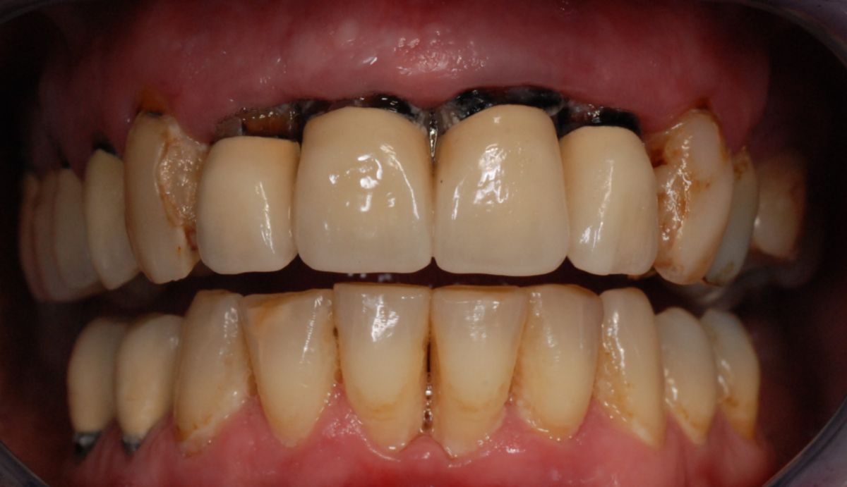 Freiliegende Kronenränder nach Zahnfleischretraktion