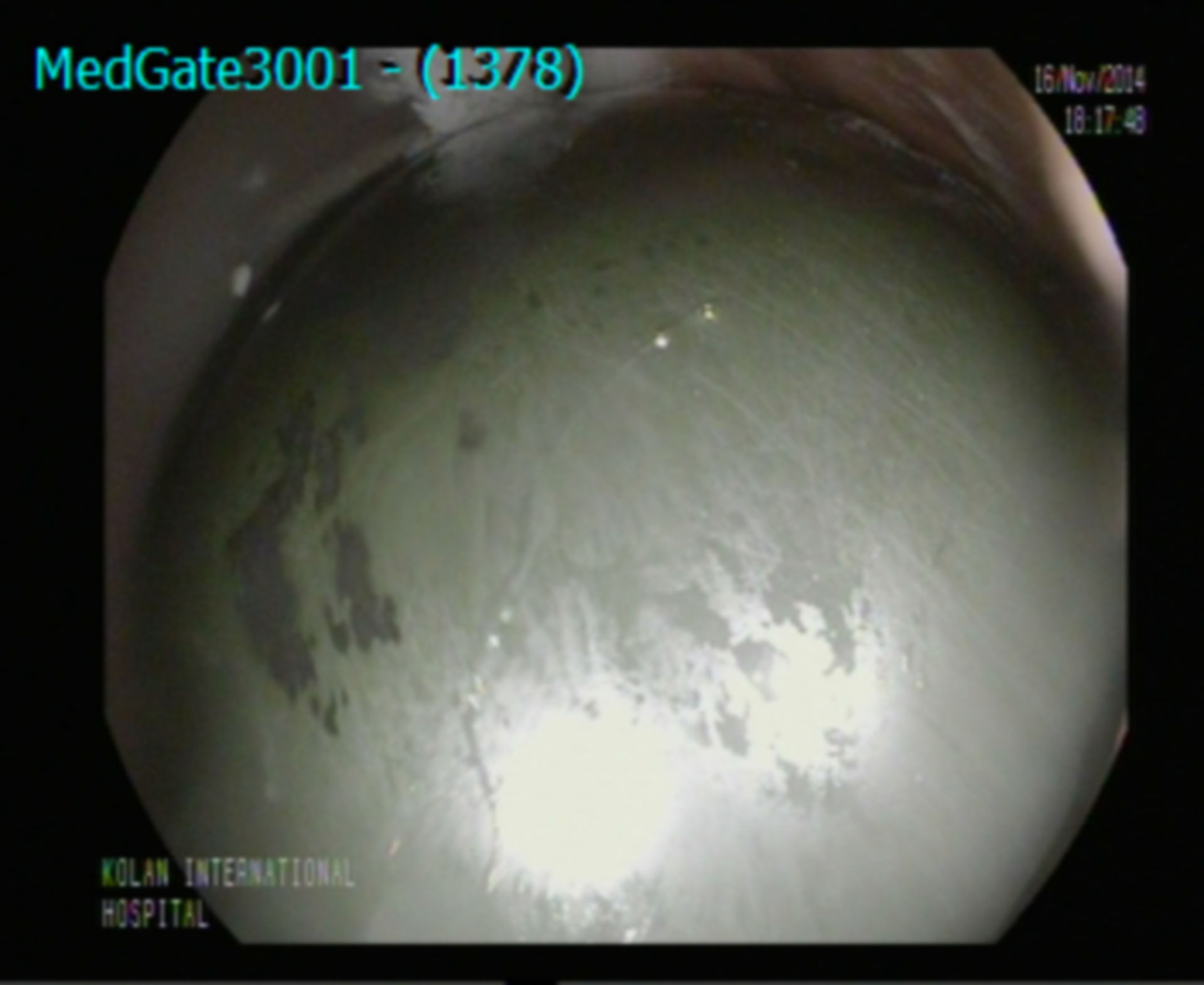 Endoscopic view of a normal filled silicone intragastric balloon