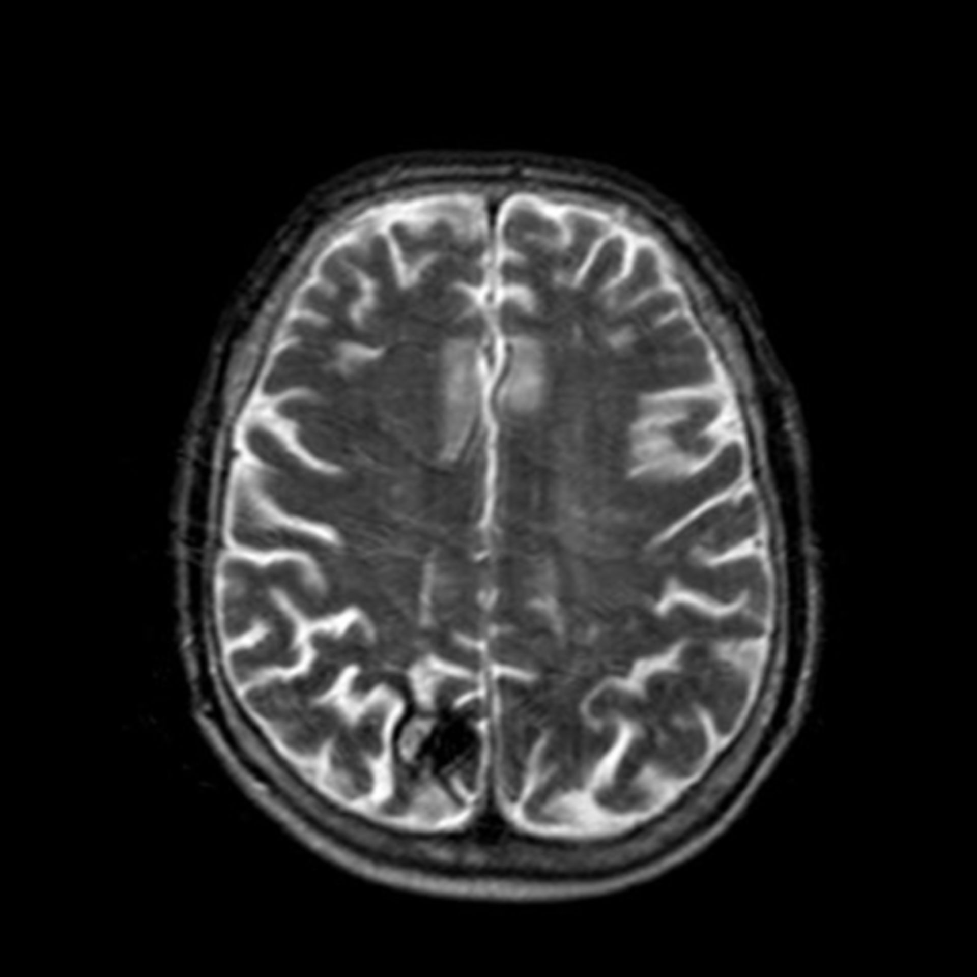 (4) MRI t2 S1 I18