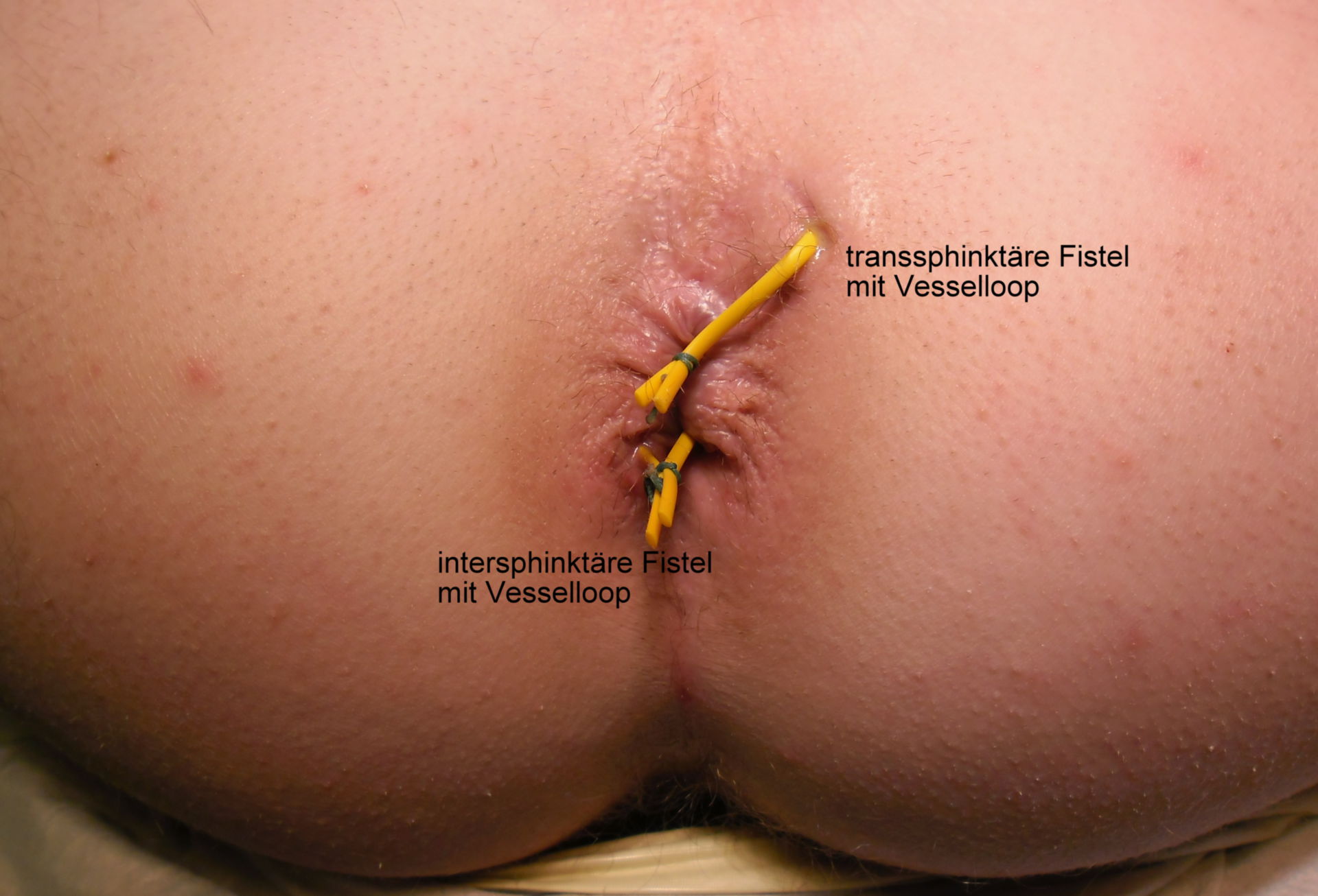 Recurrence Rate In Complex Anal Fistula Treated By Photo.