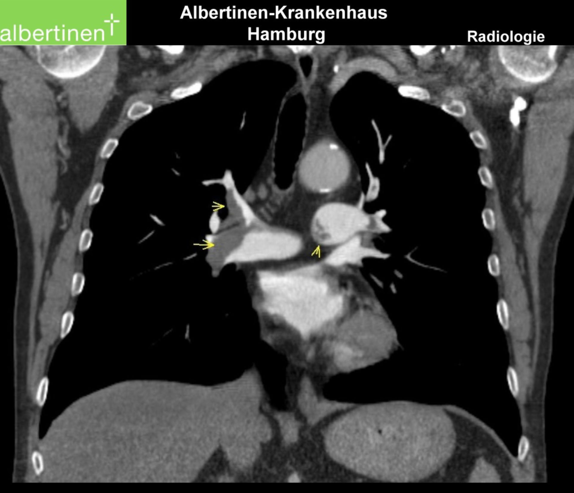 CT-Thorax Lungenembolie (2)