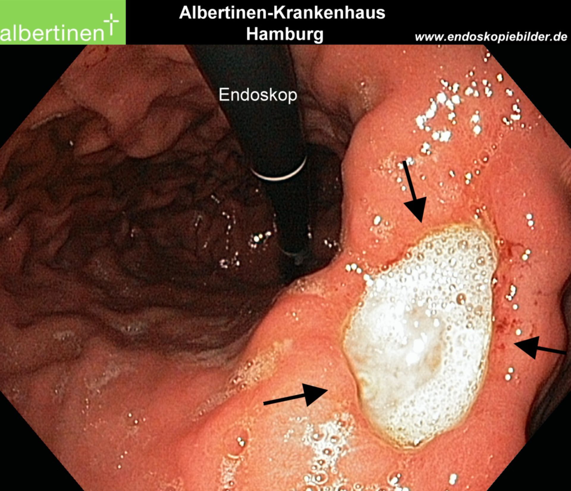 Ulcer Angulus Stomach