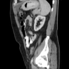 Lymphom - DocCheck Flexikon