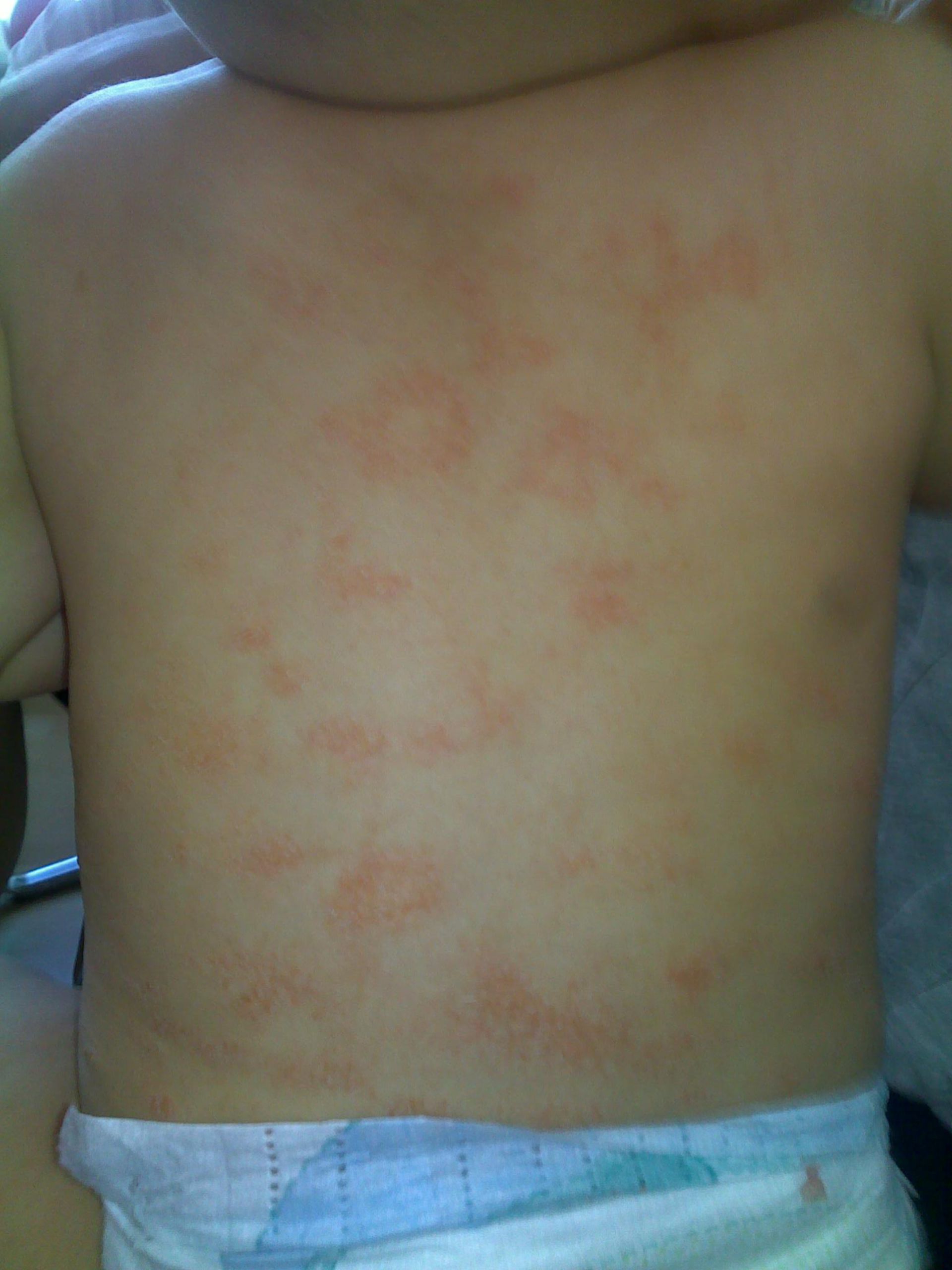 Eczema seborroica del torso infantile (2)