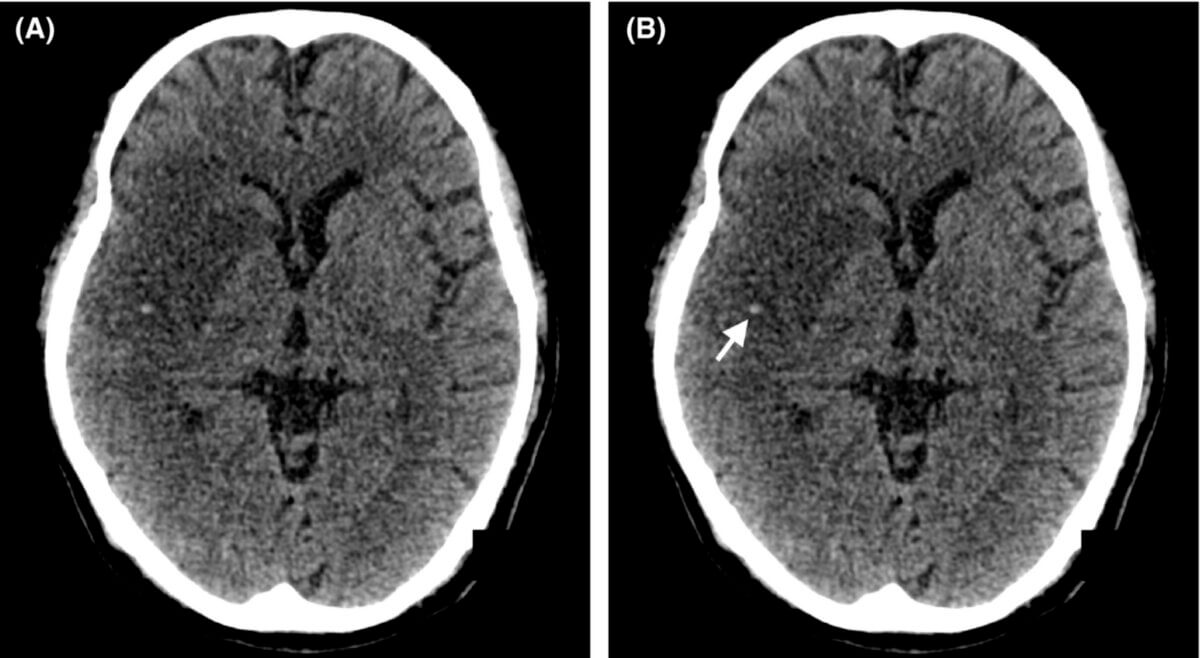 MCA dot sign bei akutem ischämischem Schlaganfall (CT)