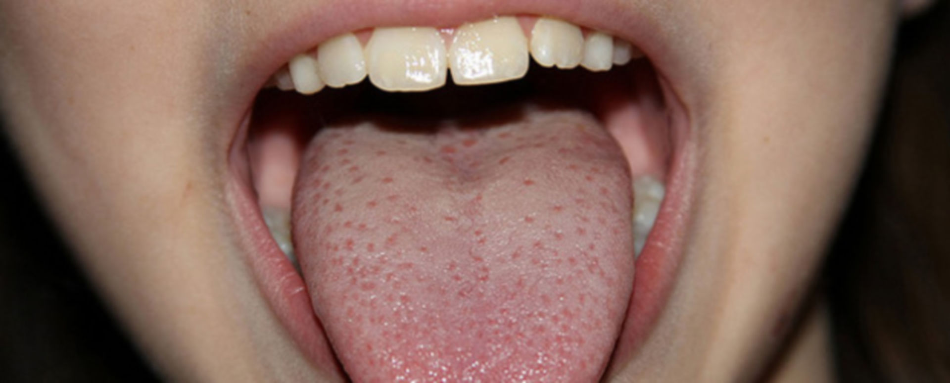 Die Nacht gehört dem Zungenschrittmacher DocCheck