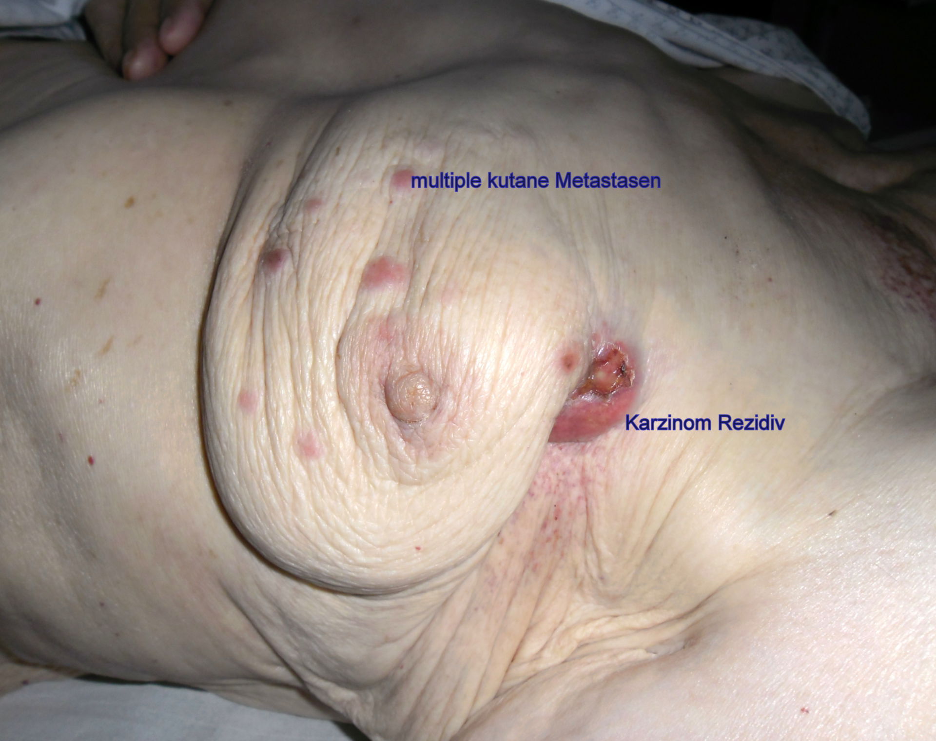 Mammary carcinoma, relapse