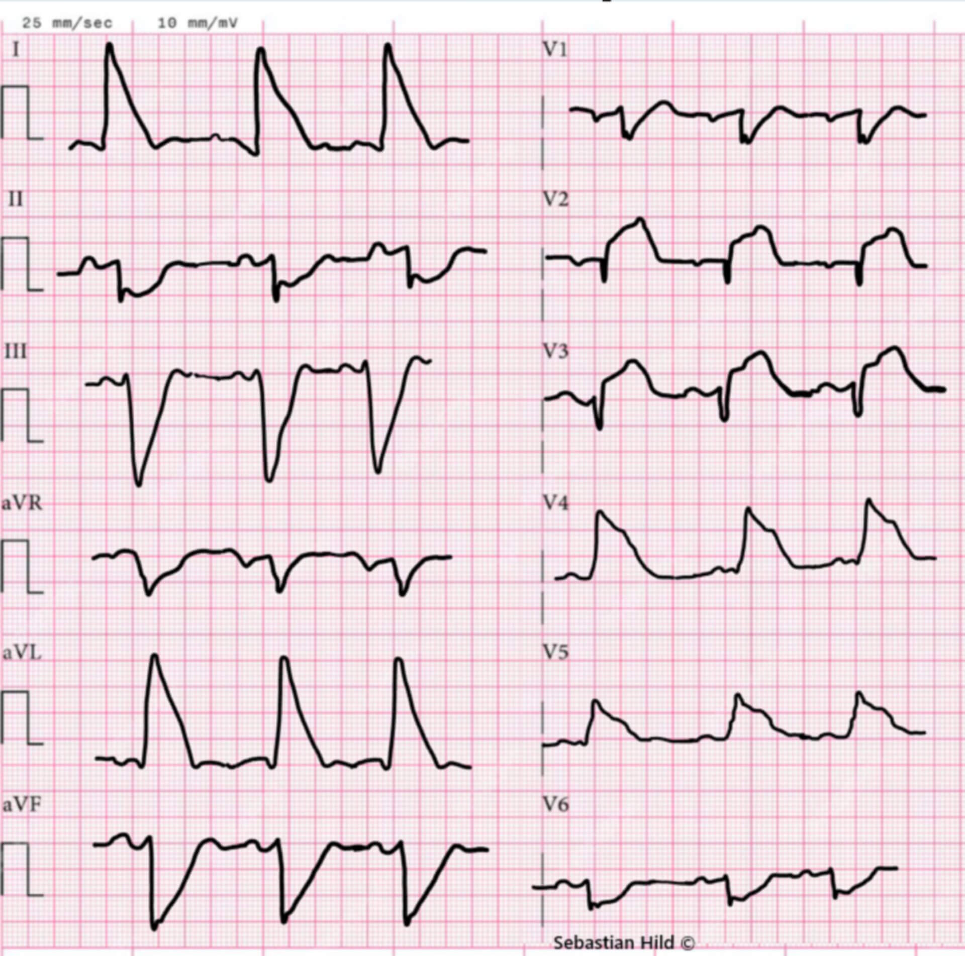 Shark-Fin EKG