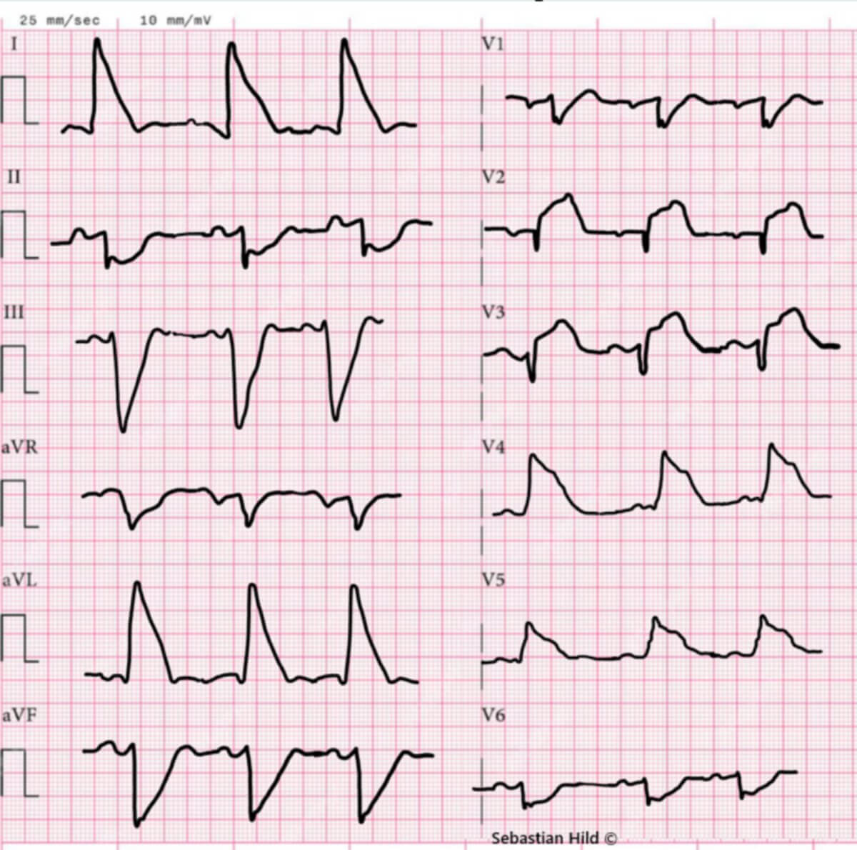 Shark-Fin EKG