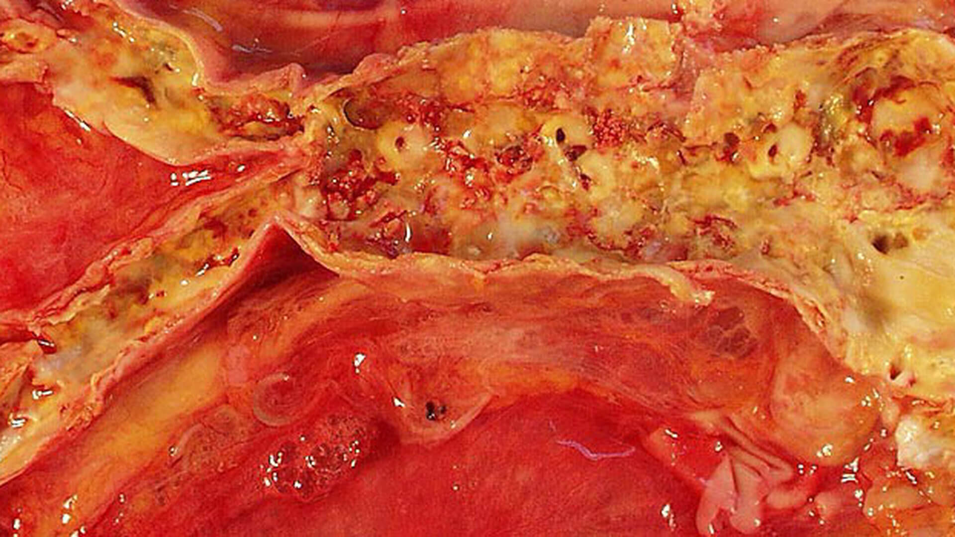 Atherosklerose der Aorta