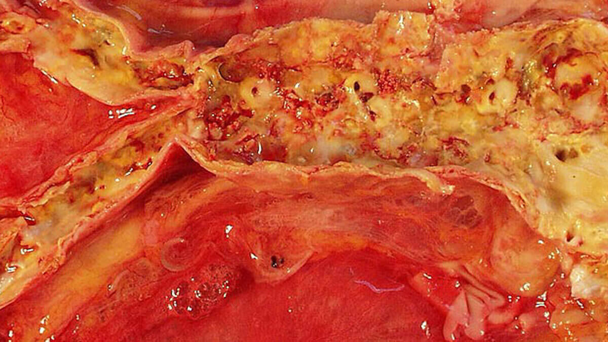 Atherosklerose der Aorta