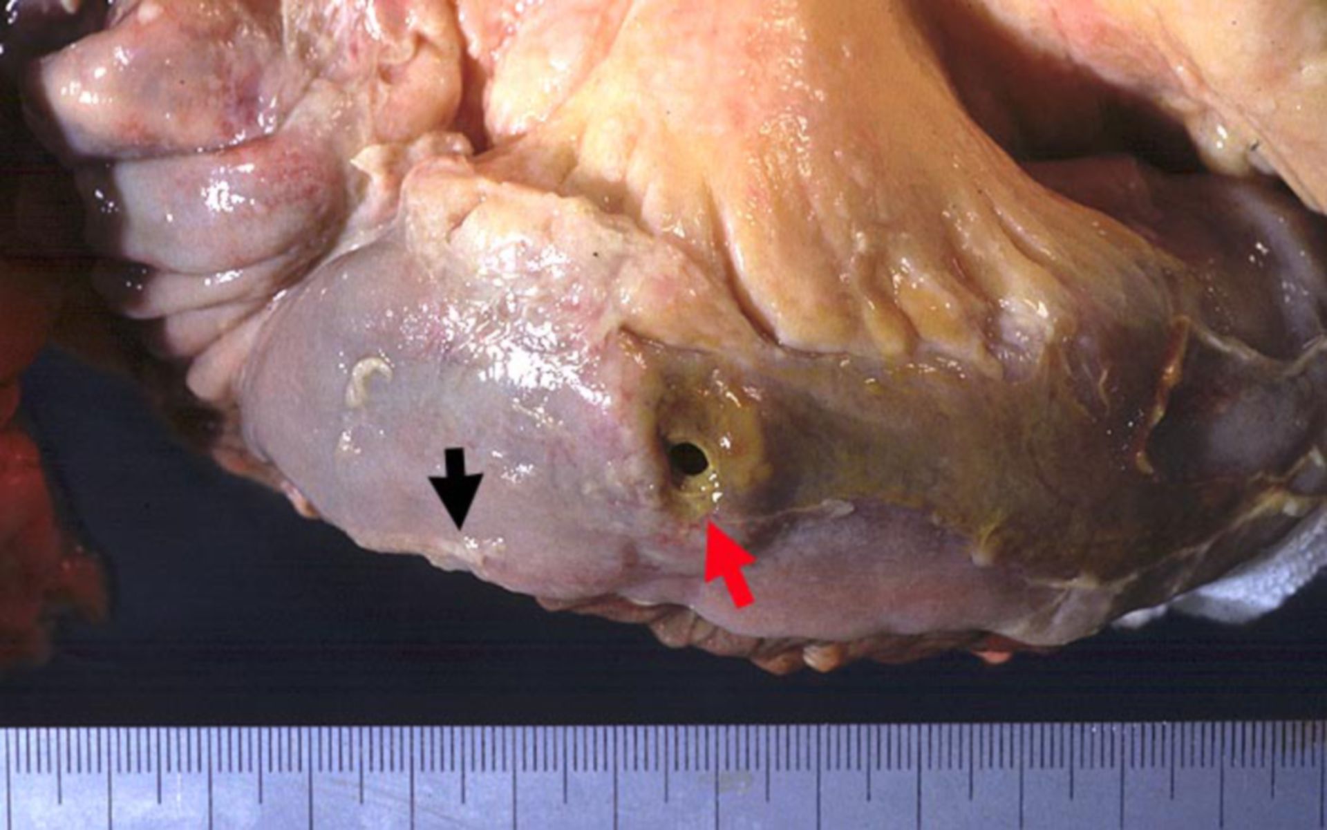 Darmperforation (Metastase eines Adenokarzinoms der Lunge)