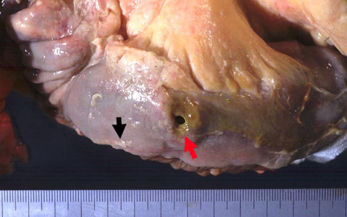 Darmperforation (Metastase eines Adenokarzinoms der Lunge)