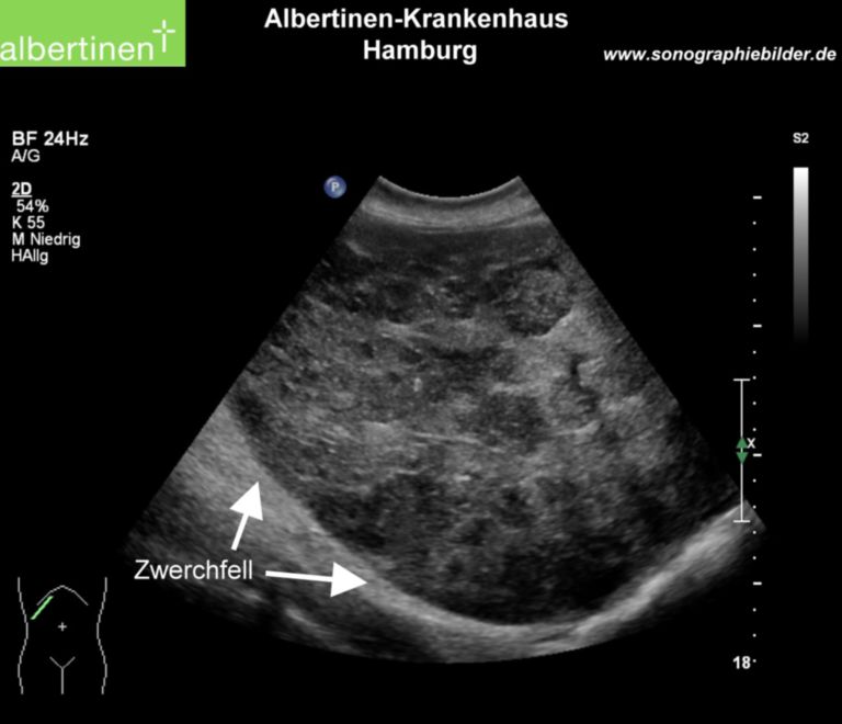 Multiple metastasi epatiche frecce - DocCheck