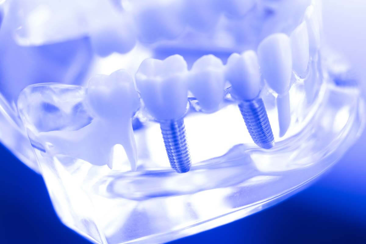 8_important_reasons_to_restore_missing_teeth_with_dental_implant_original.jpg