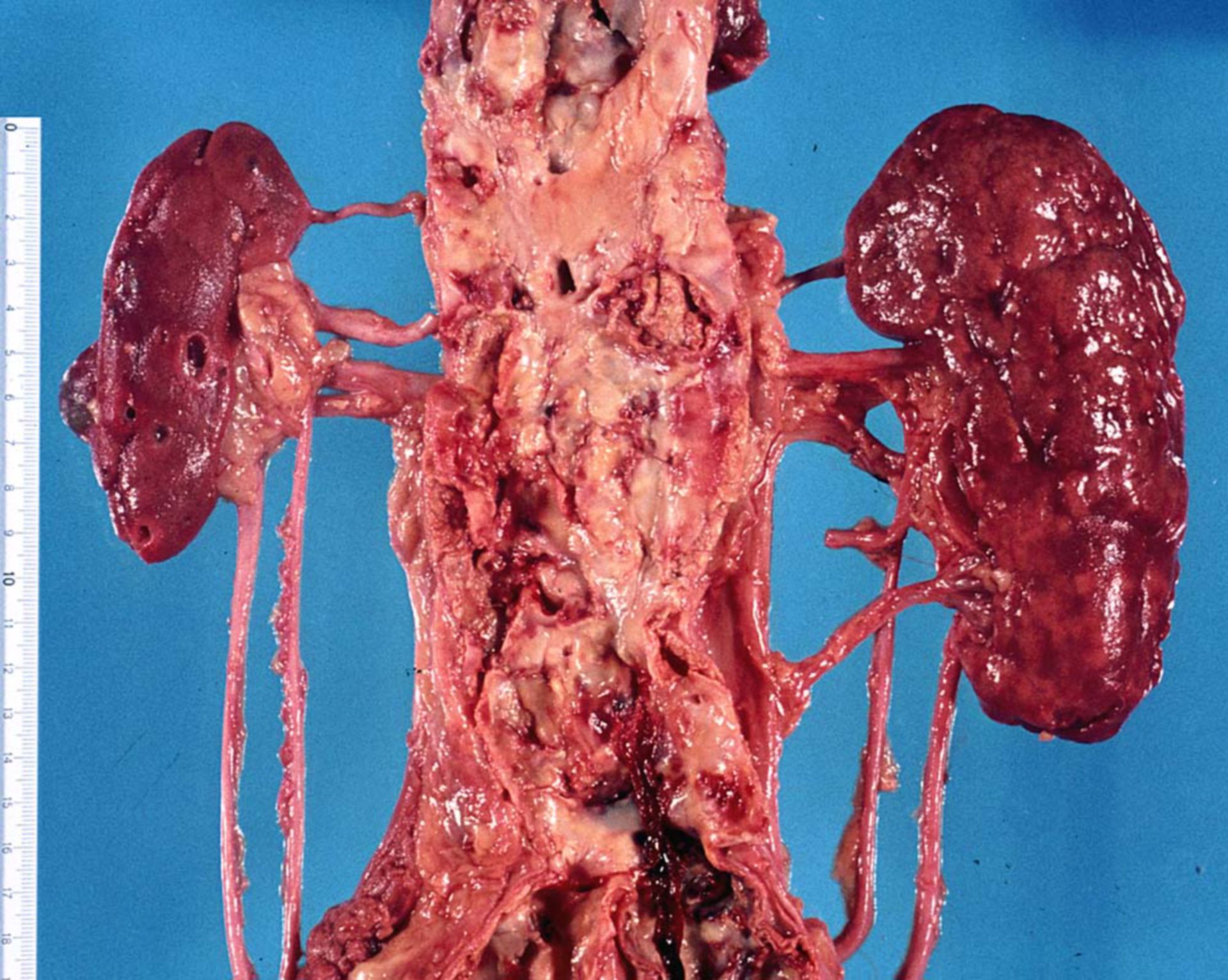 Cirrhotic kidney in renal arterial stenosis