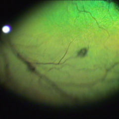 Chorioretinitis DocCheck Flexikon