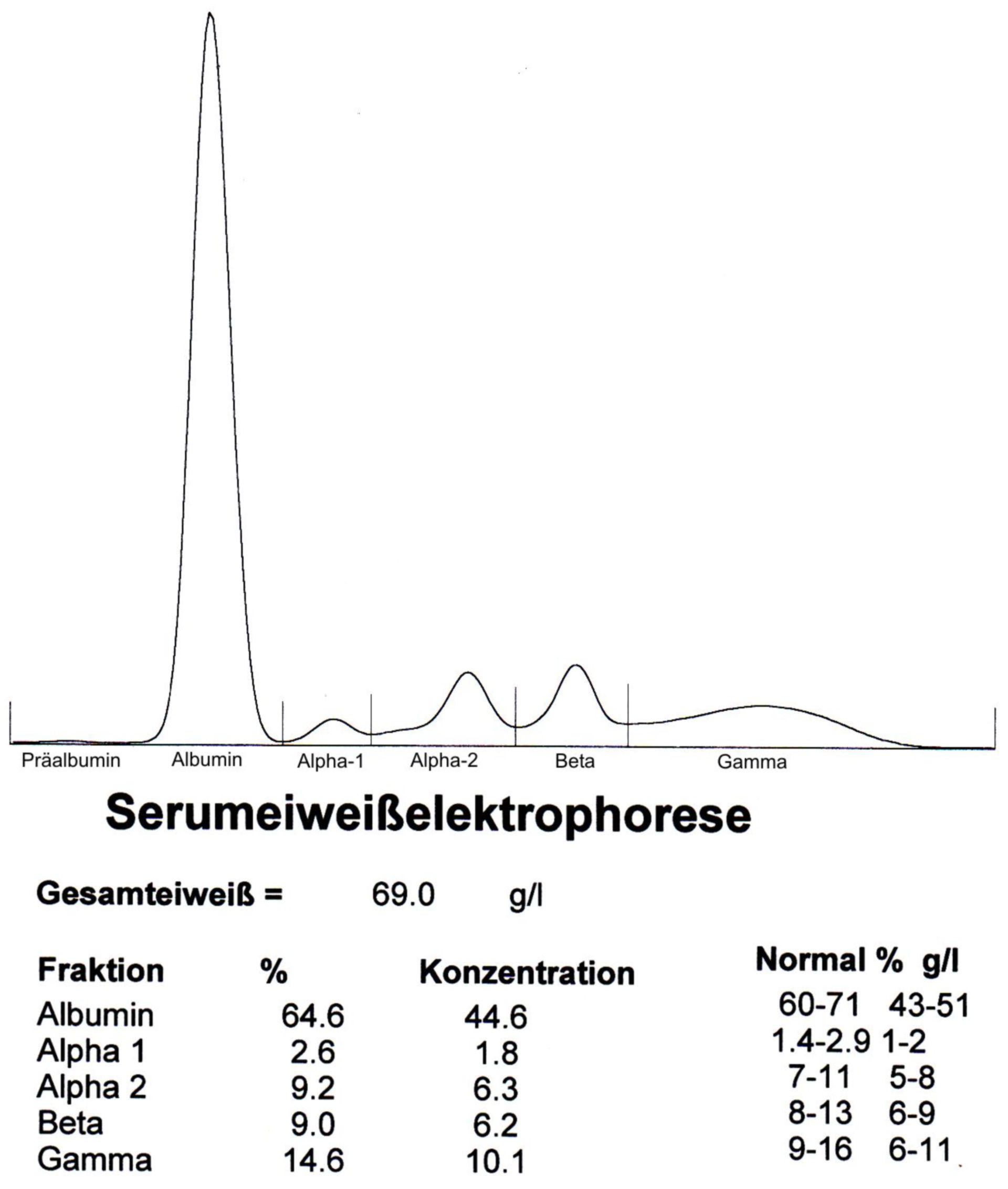 Normal serum protein electrophoresis