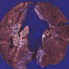 Sarkoidose DocCheck Flexikon