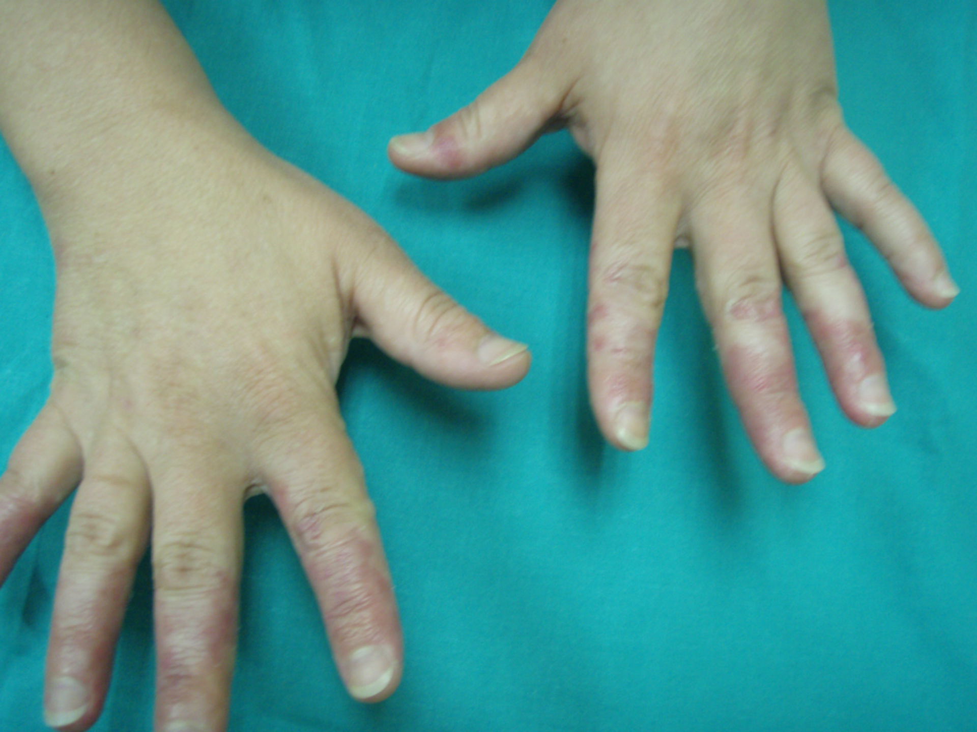 Dermatite delle dita dopo il trattamento