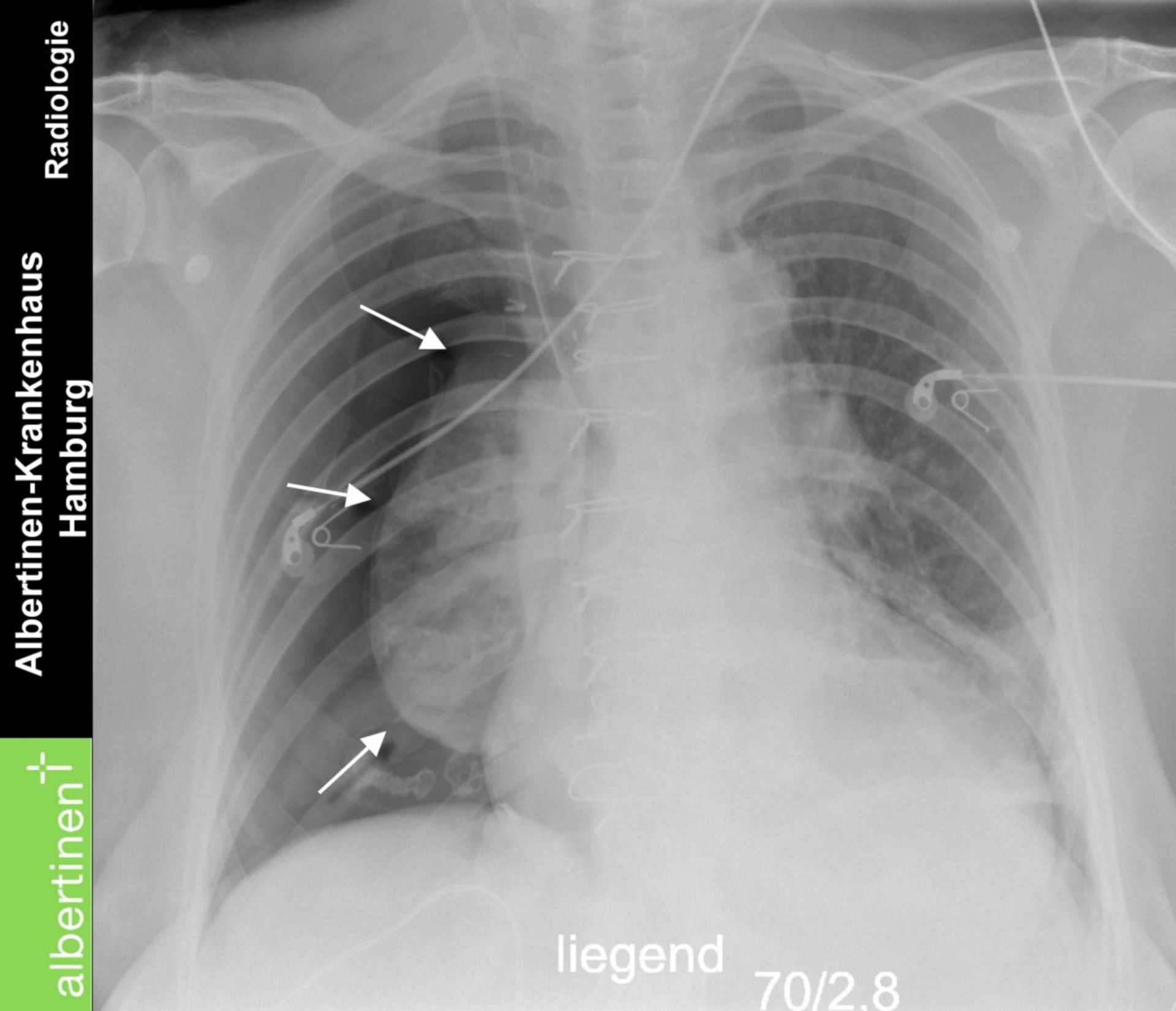 Pneumothorax v Saugung