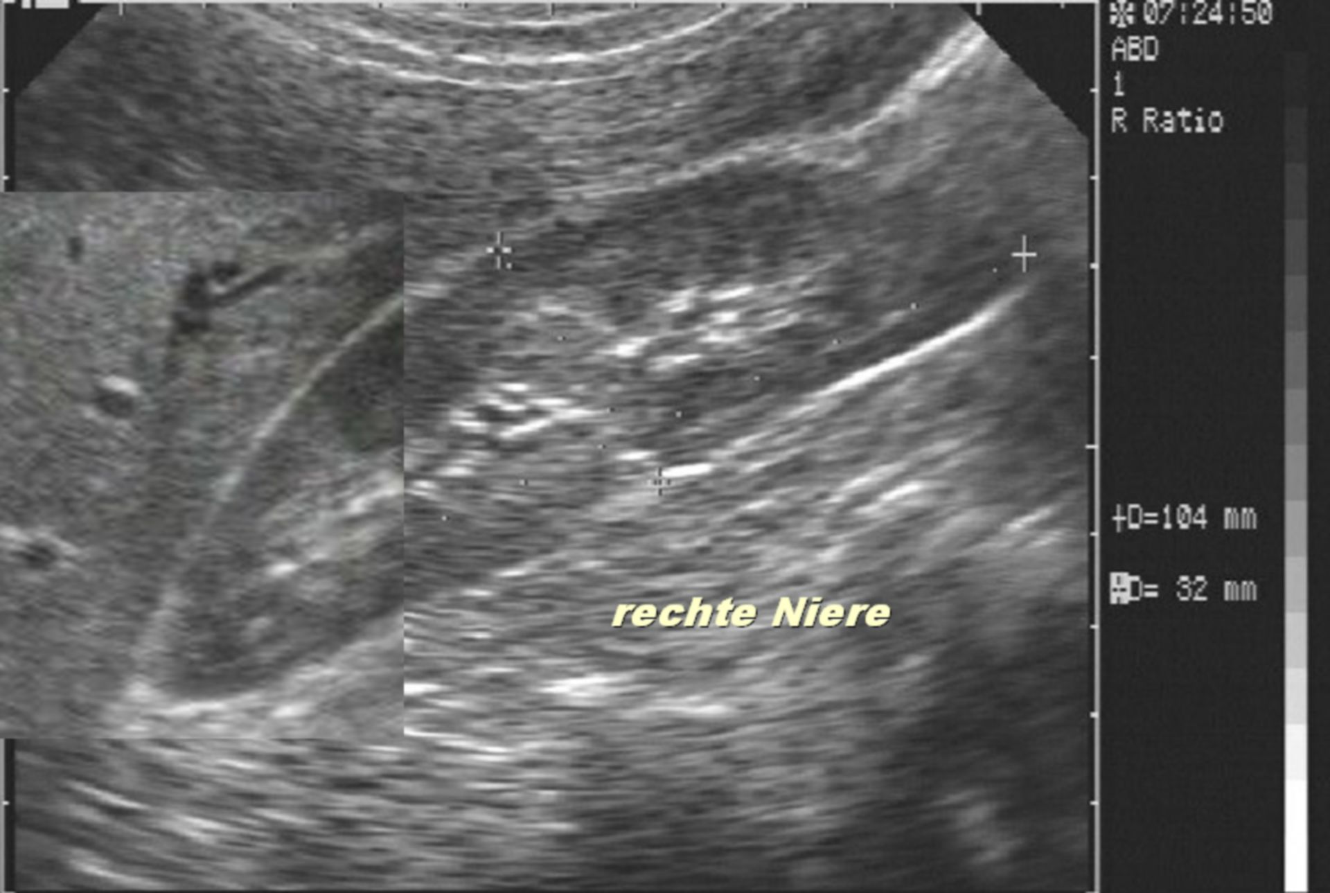 Normal Finding of the Kidney
