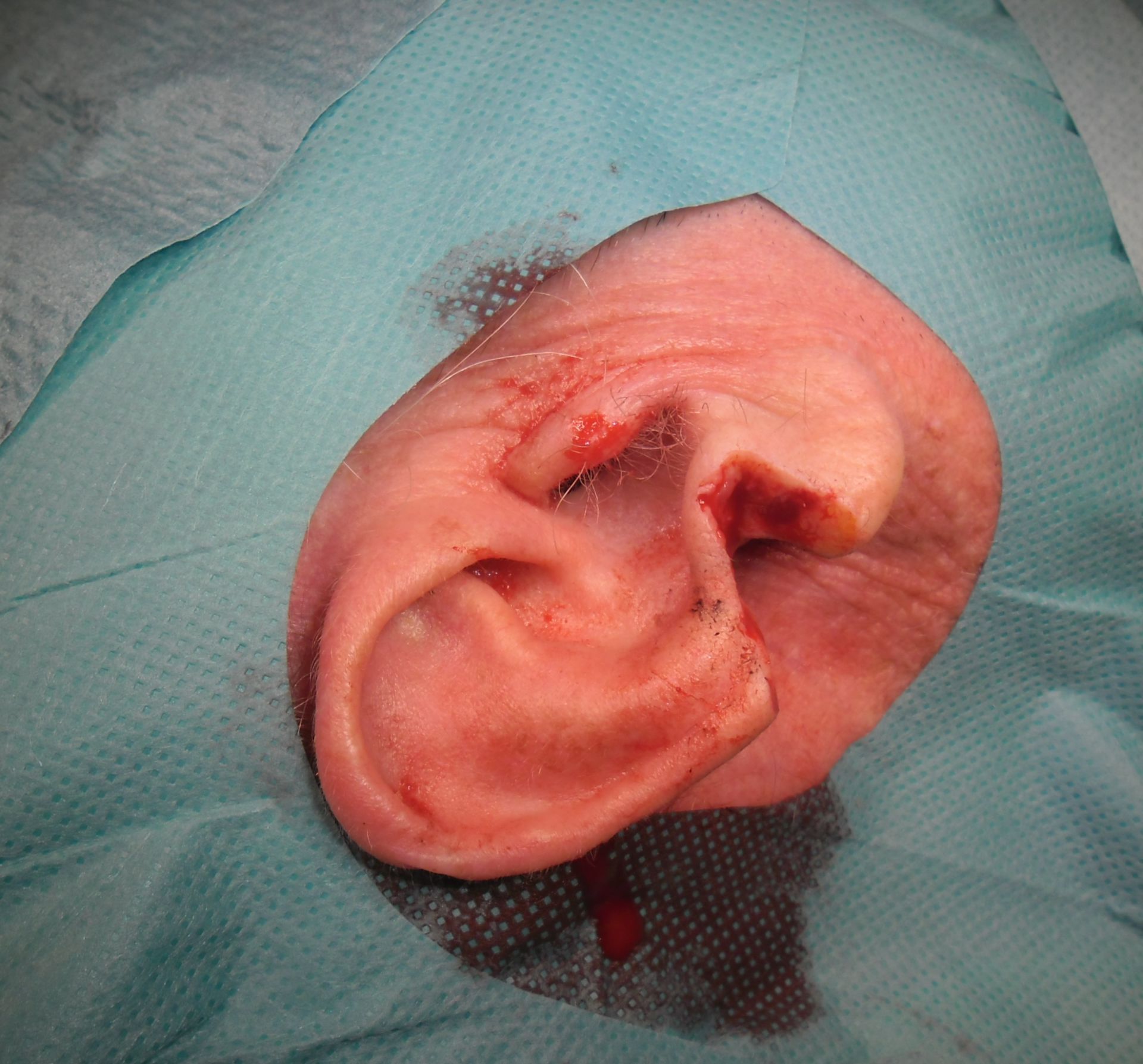 Tumor en oreja - intraoperativo