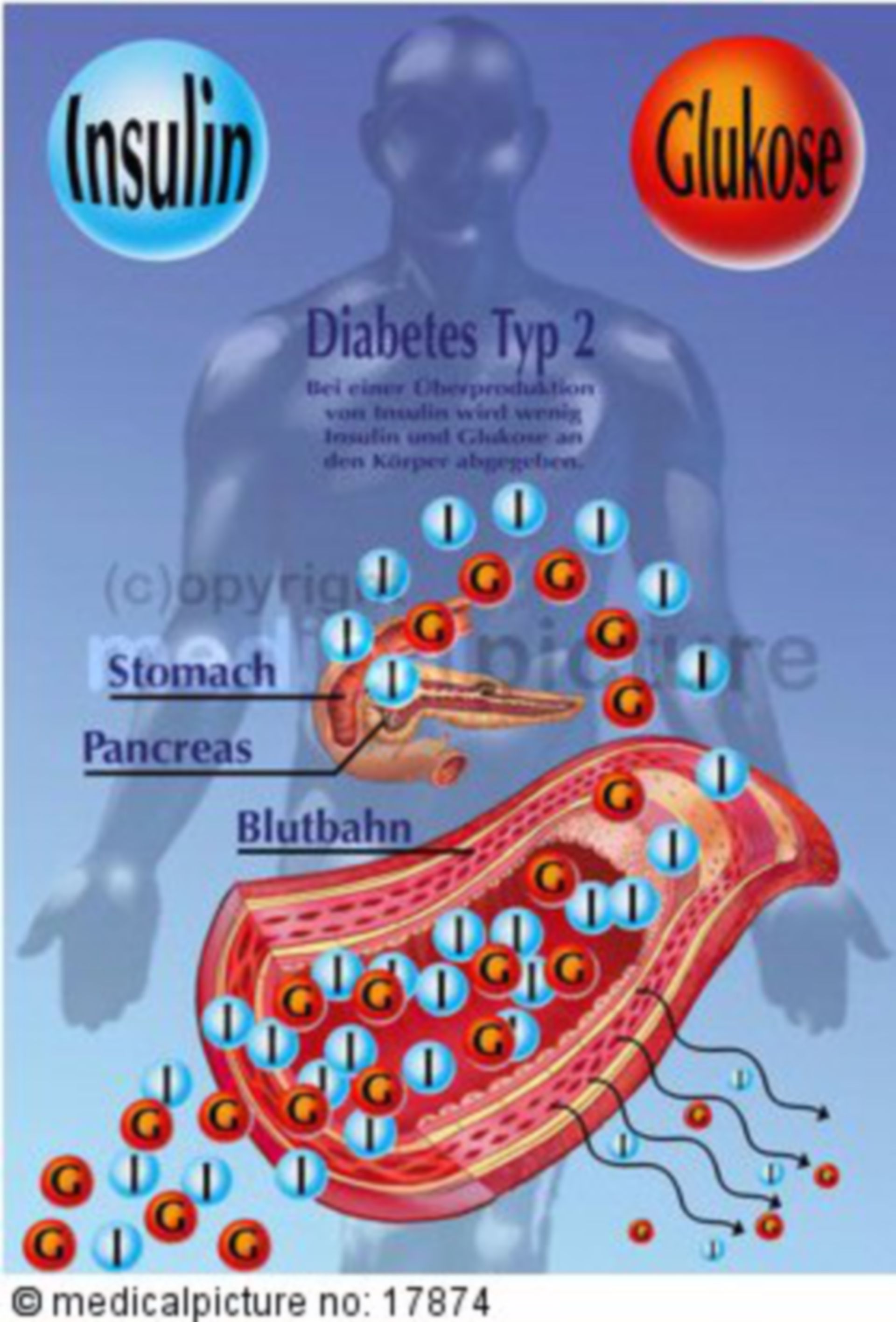 Insulinsekretion bei Menschen mit Typ-2-Diabetes