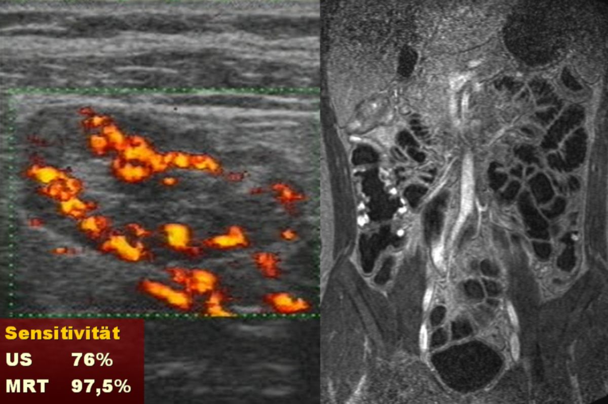 Morbus Crohn im Ultraschall und MRT