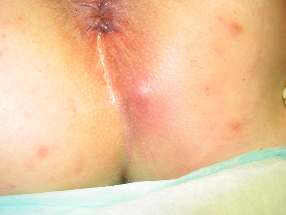 Akne inversa (Hidradenitis suppurativa)