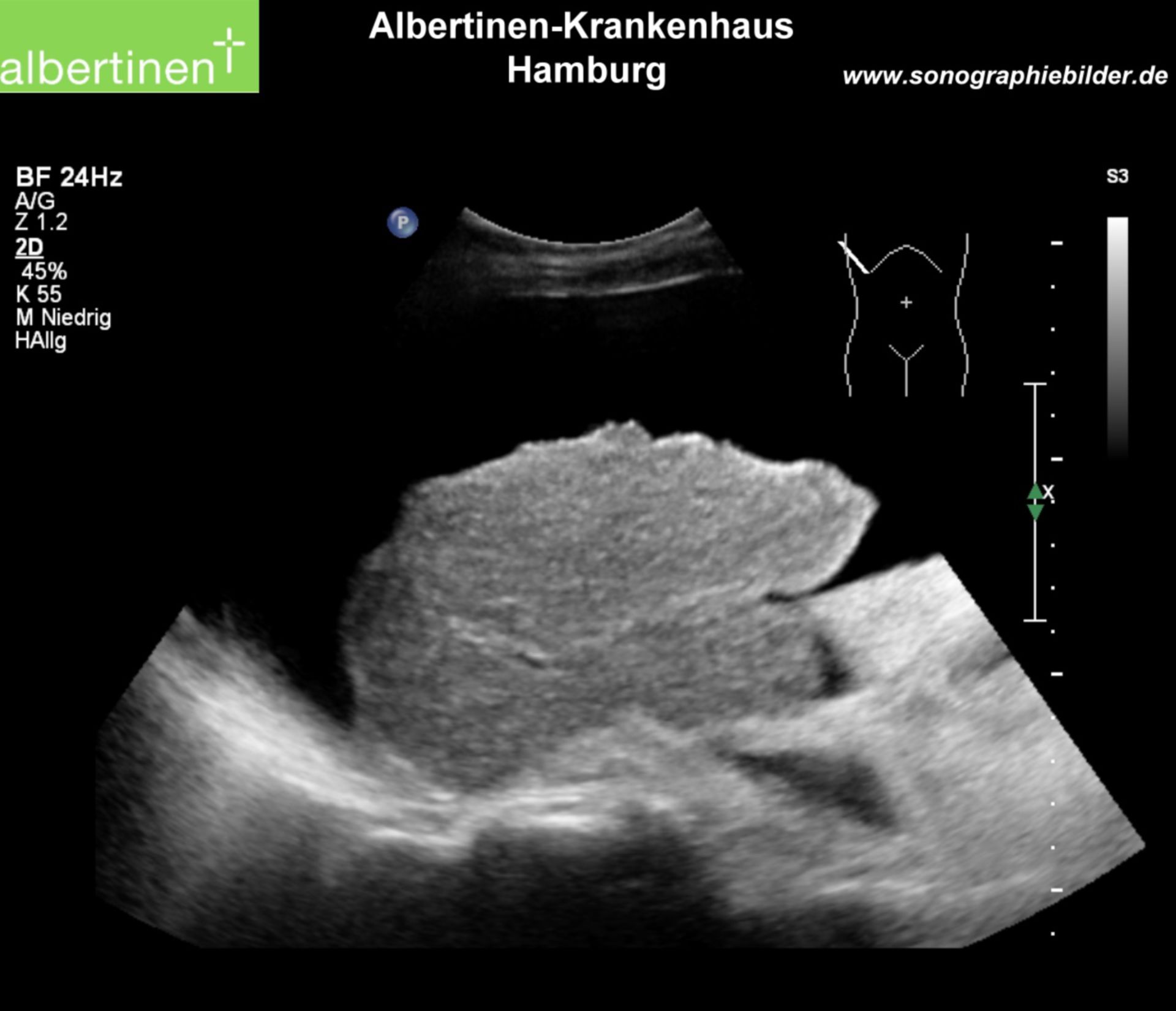 Cirrhosis, small liver, ascites (ultrasound)