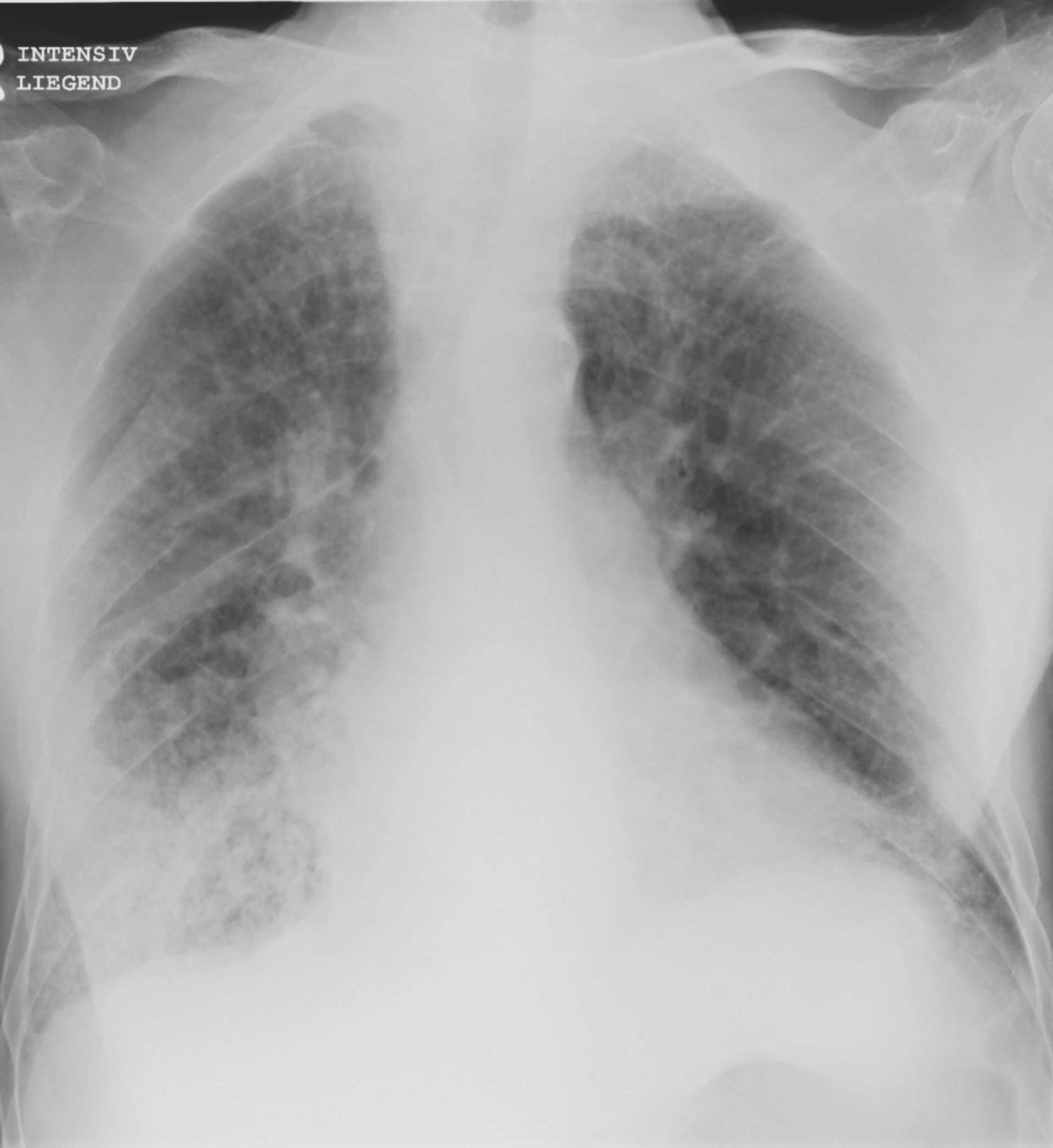 Röntgen des Thorax mit einer Stauung der Lunge beidseits perihilär