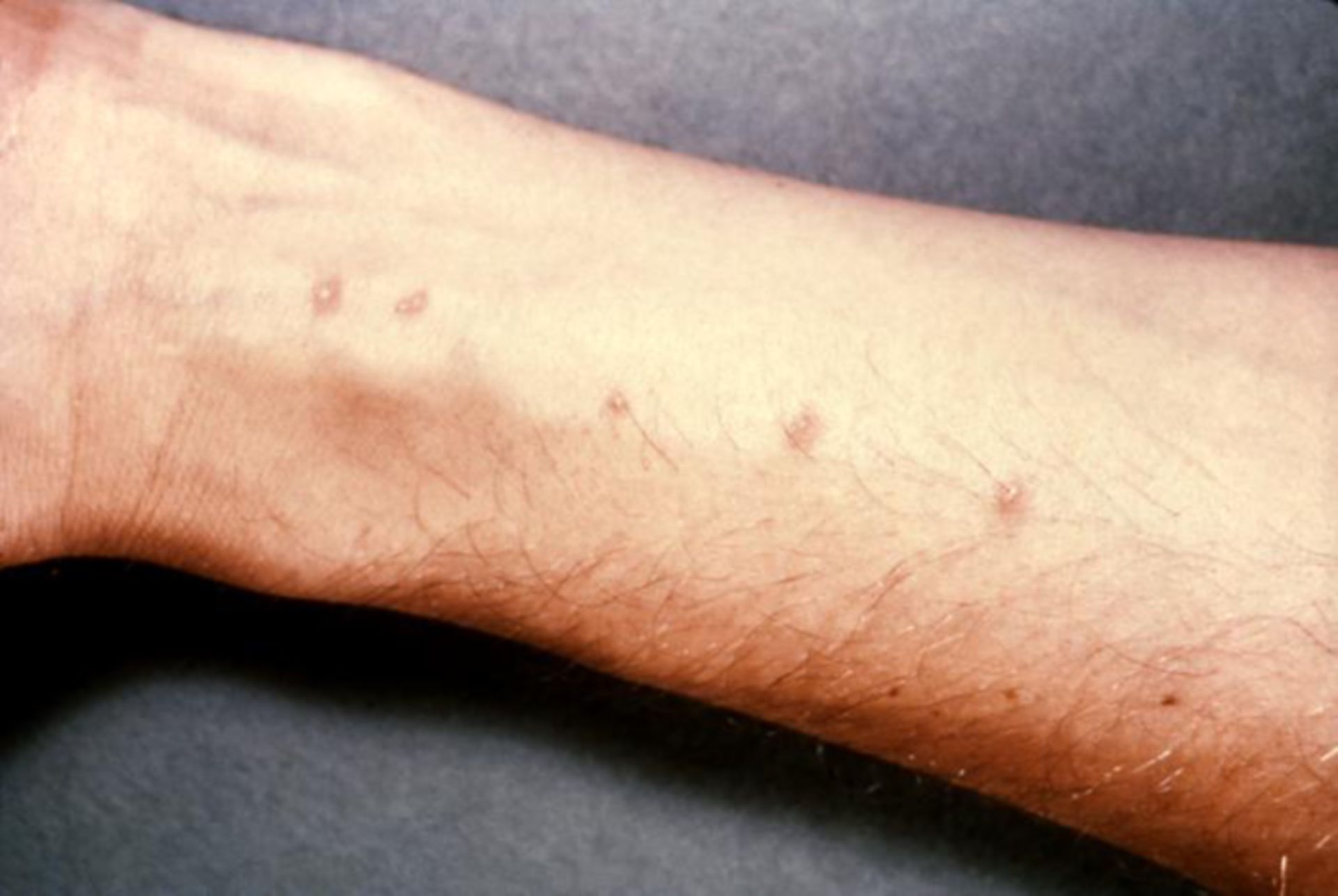 Dermatitis due to cercaria