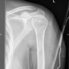 Röntgenuntersuchung der Schulter - DocCheck Flexikon