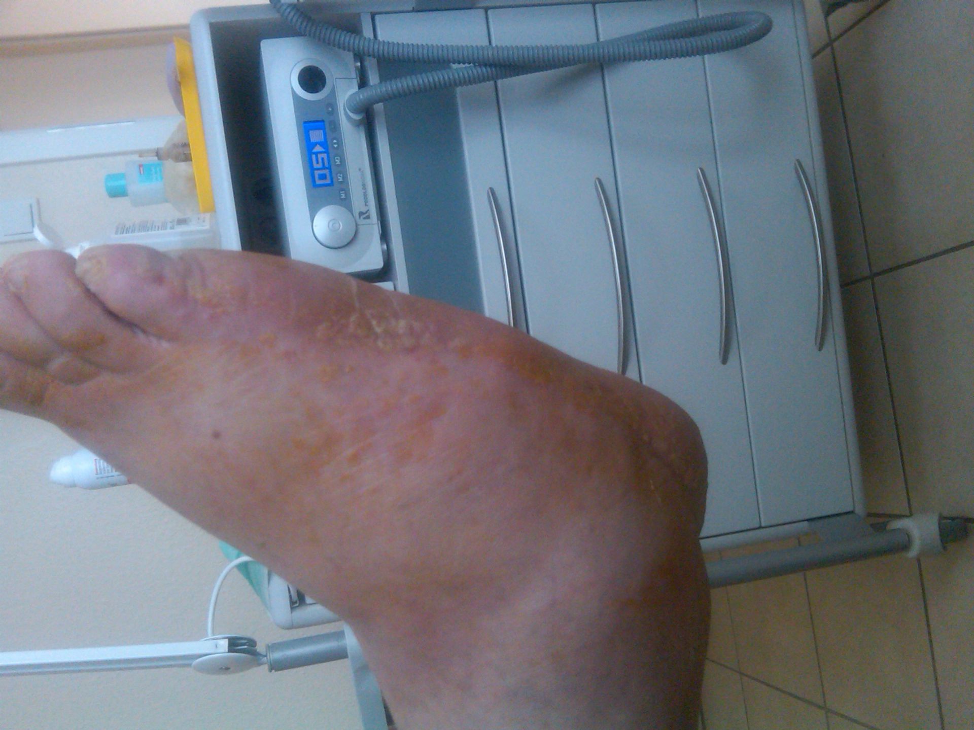 Plantar hyperceratosis