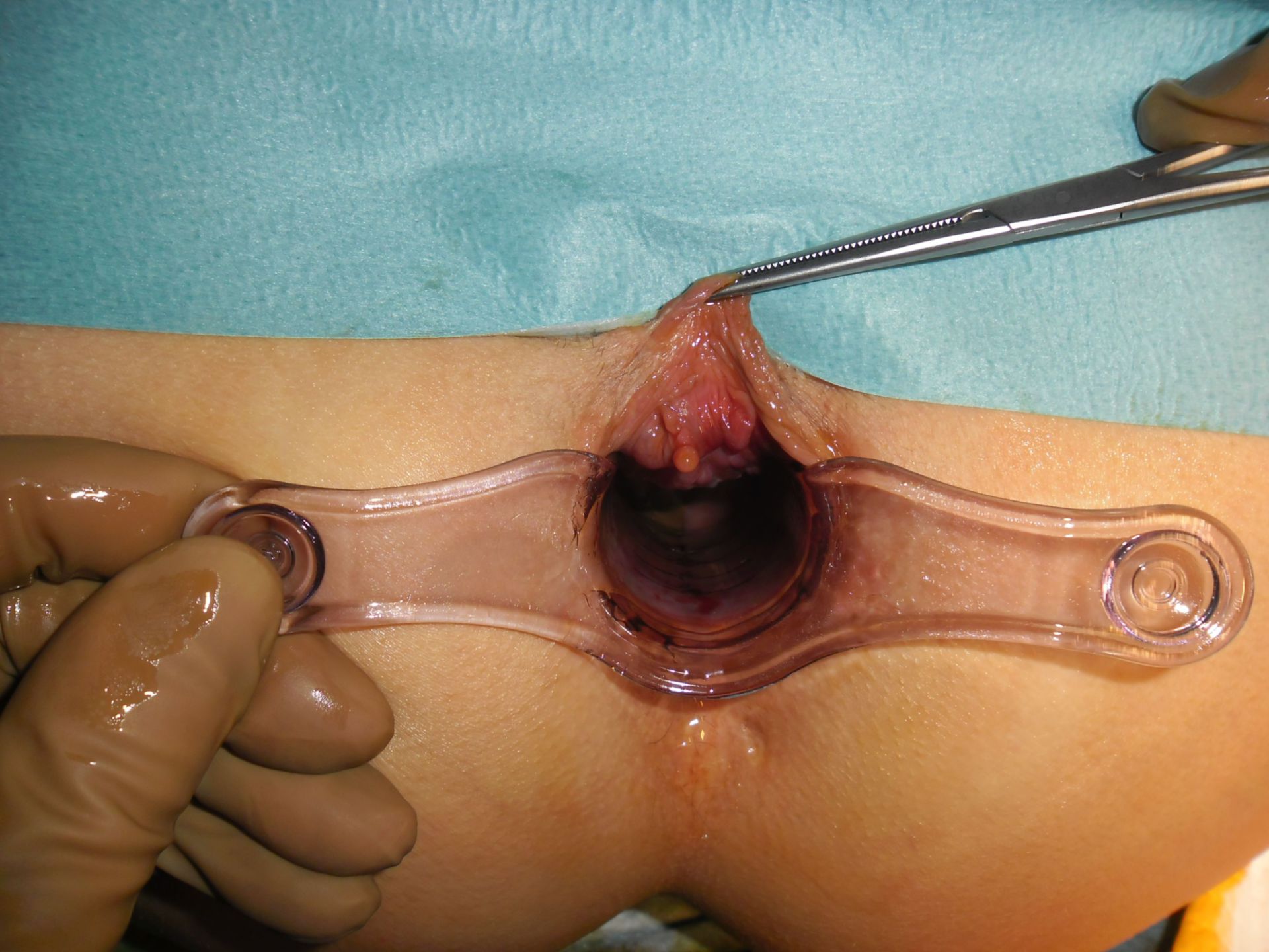 Fibroma anal