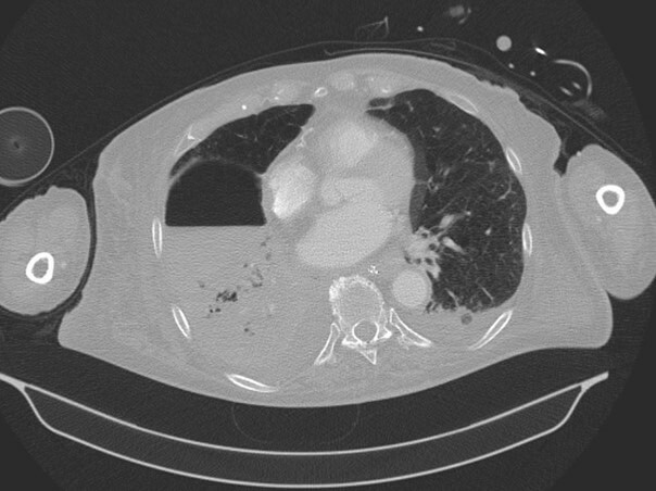 doccheck_-_08_-_infektiologische_notfa_lle_bild2_pneumonie_original.jpg