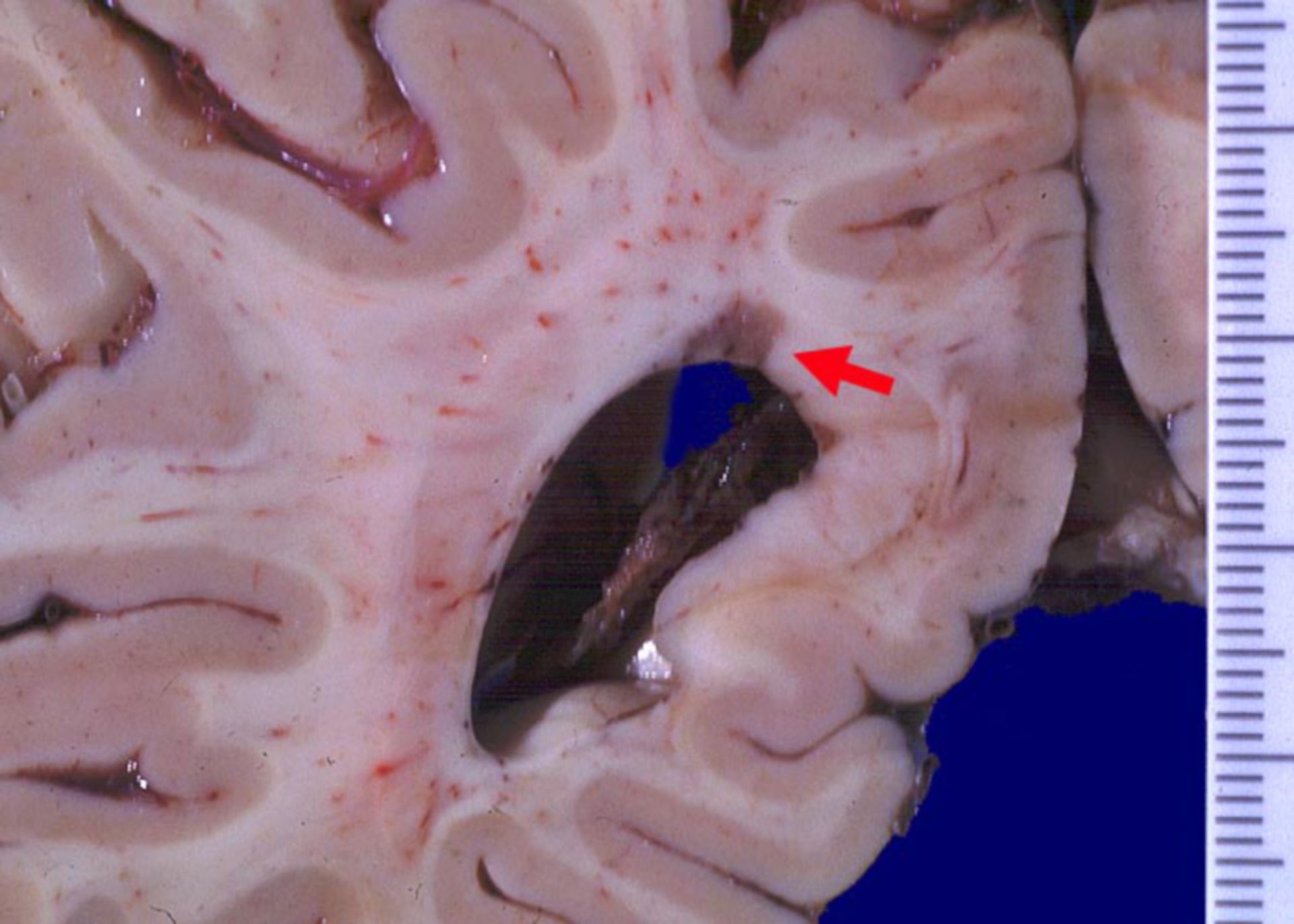 Centres of demyelinization in multiple sclerosis (MS)