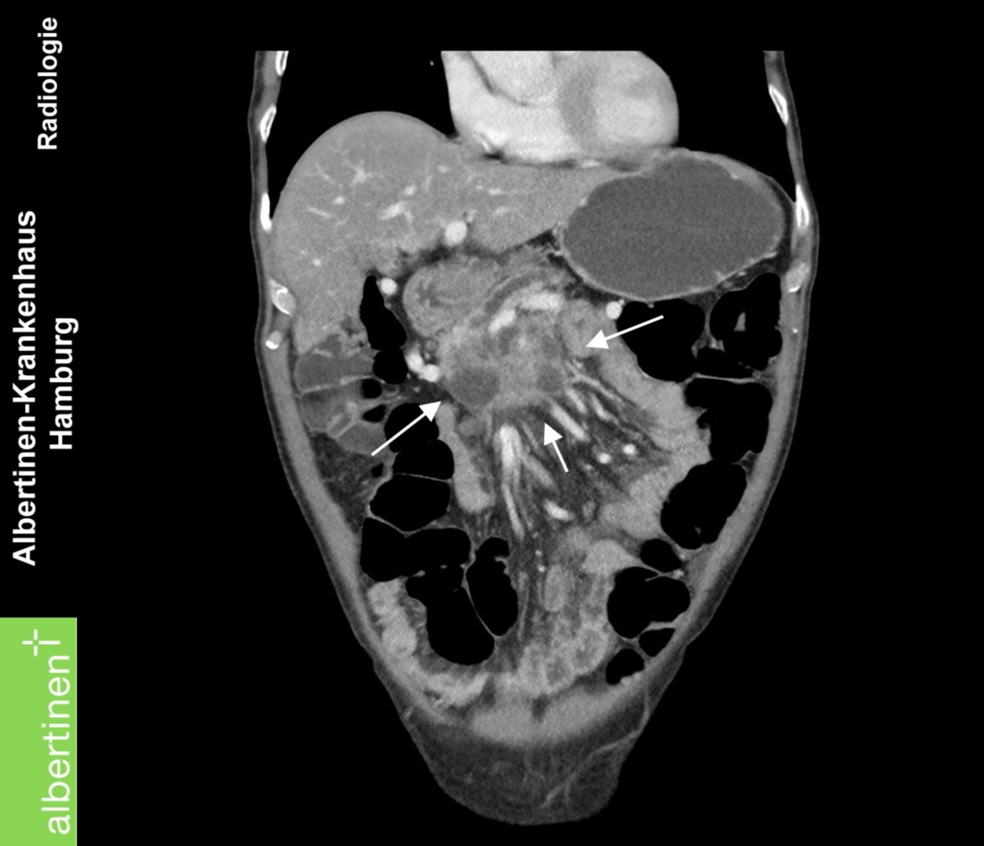 Pankreas-Kopf-Ca CT coronar