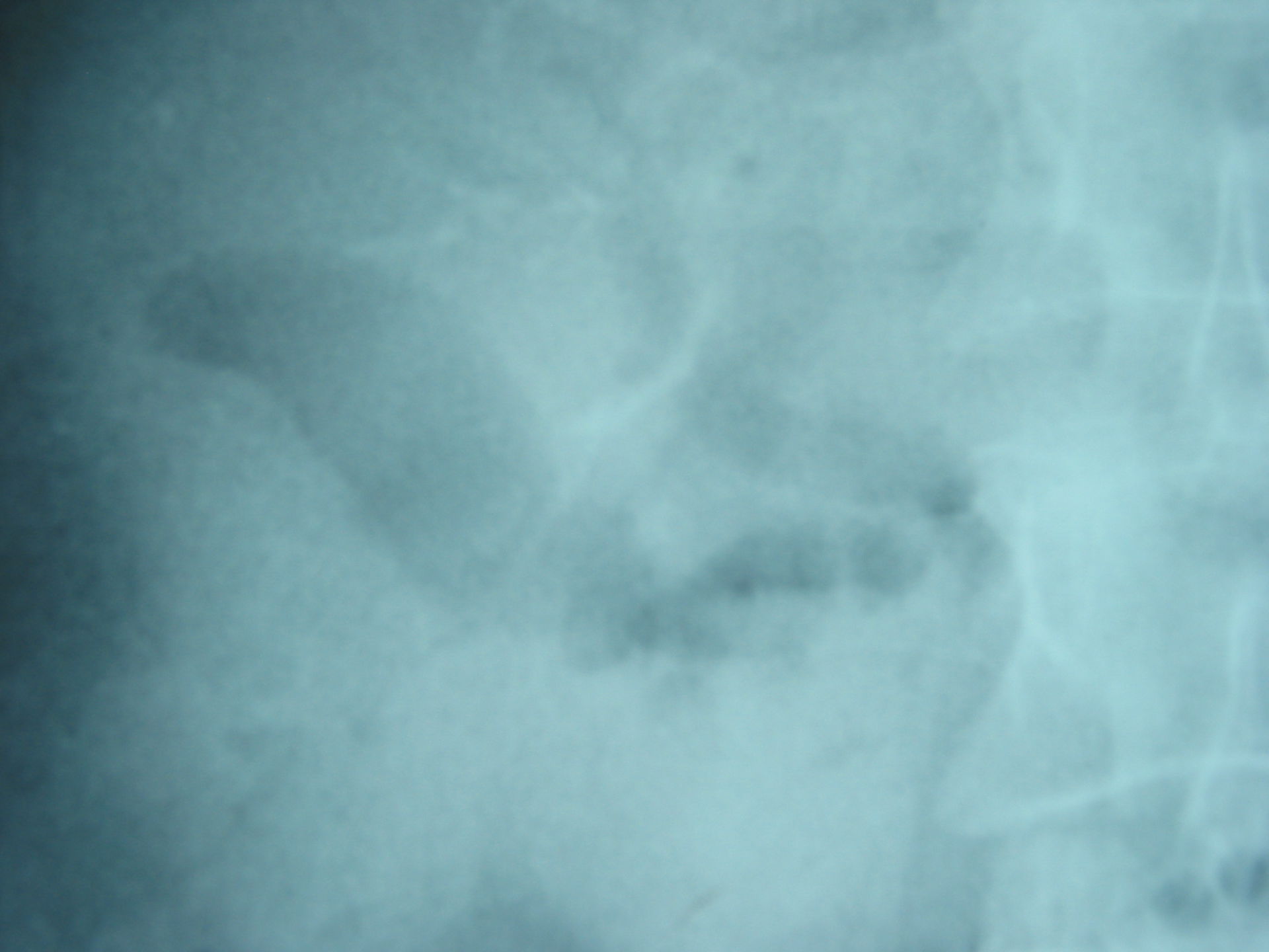 Pneumobilia in a patient with gallstone ileus