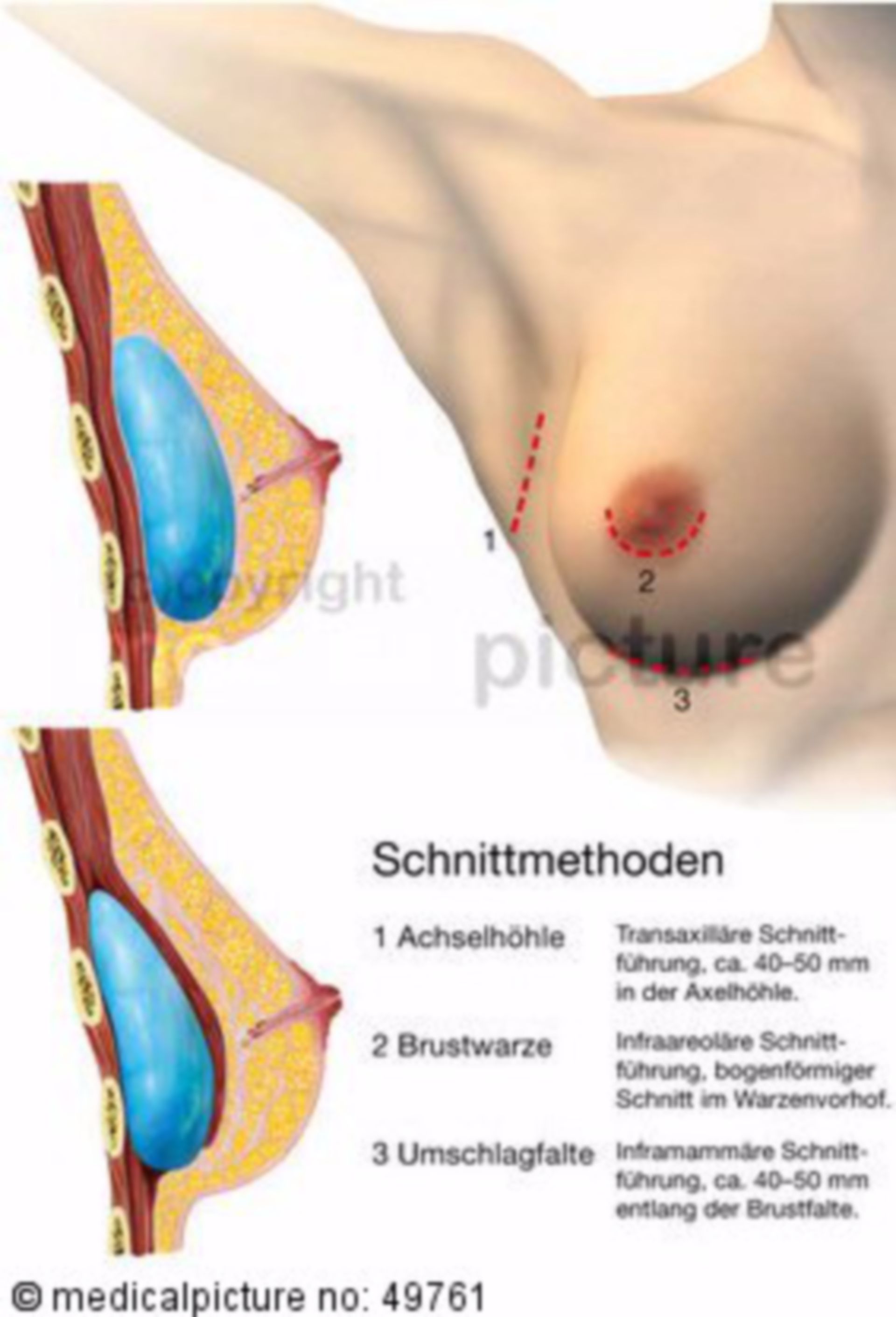 Breast implant/augmentation - Incisions