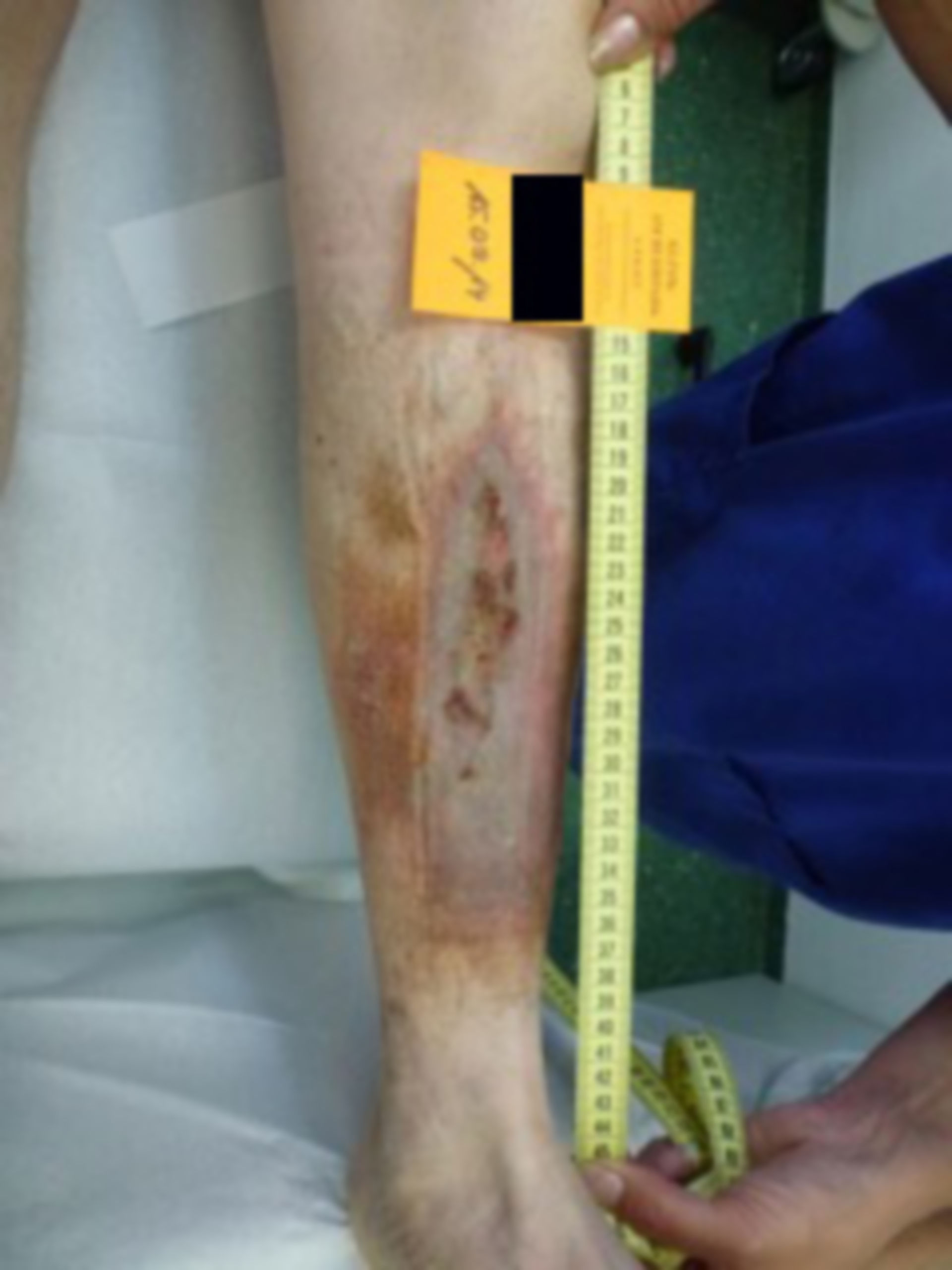 Ulcer of the lower leg - 20 years open: (10)
