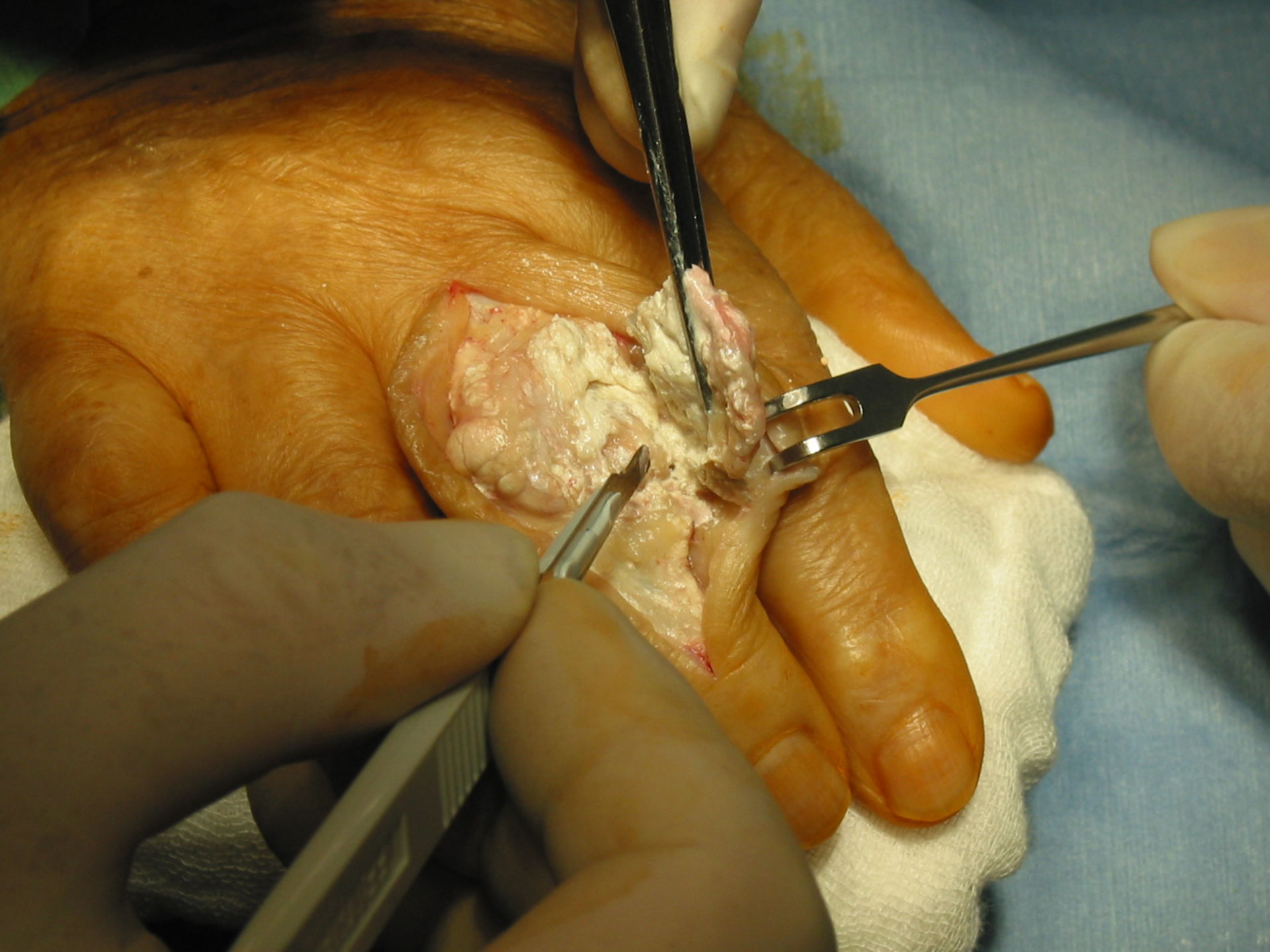Gichttophus Finger-Operation