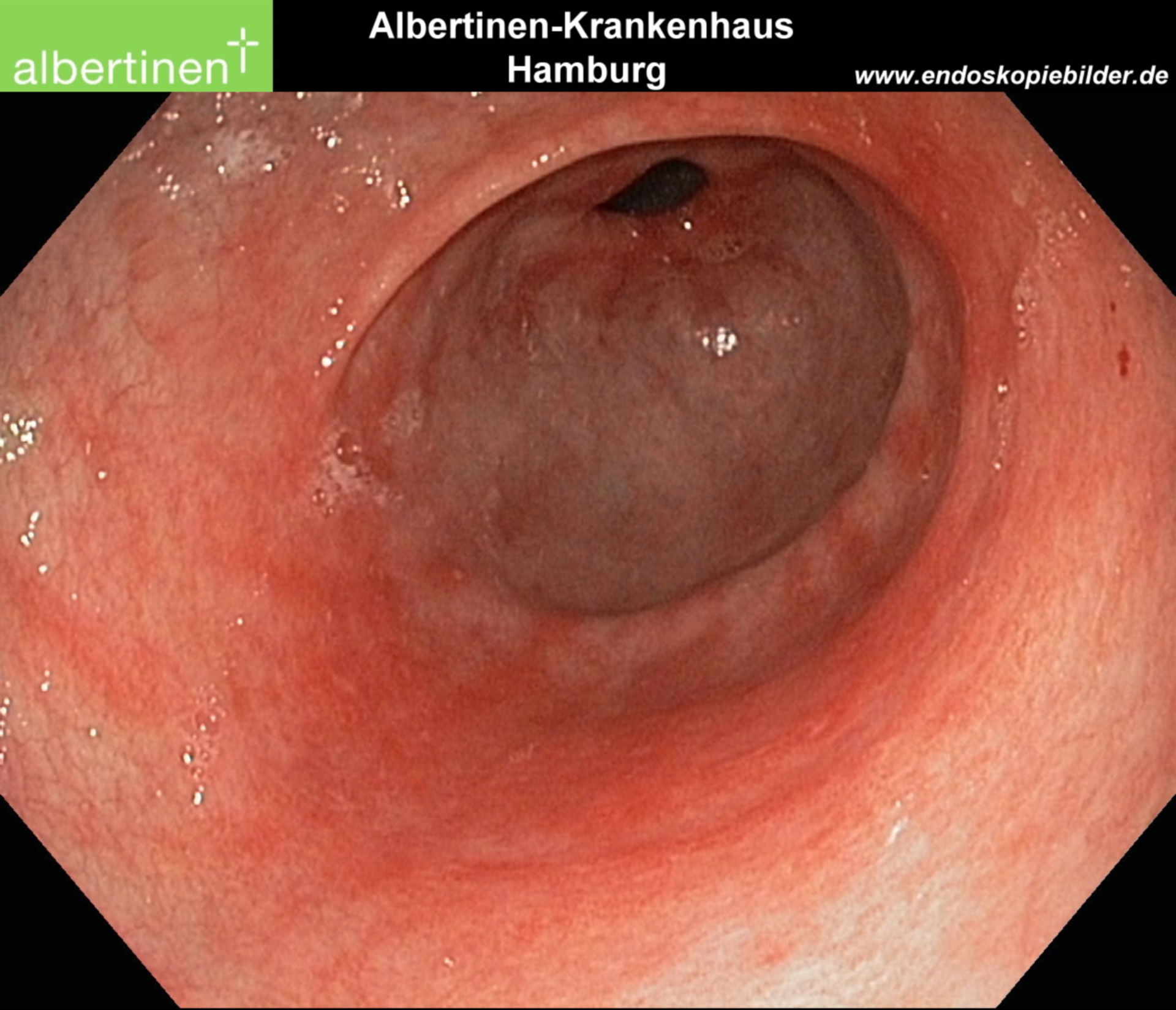 Mucosa atrophy stomach endoscopy
