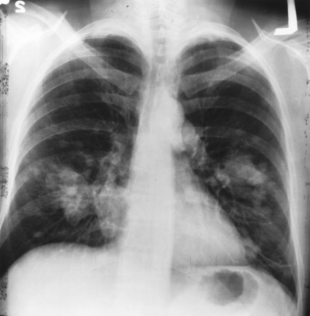 Verdacht auf Lungenkrebs (Röntgen)