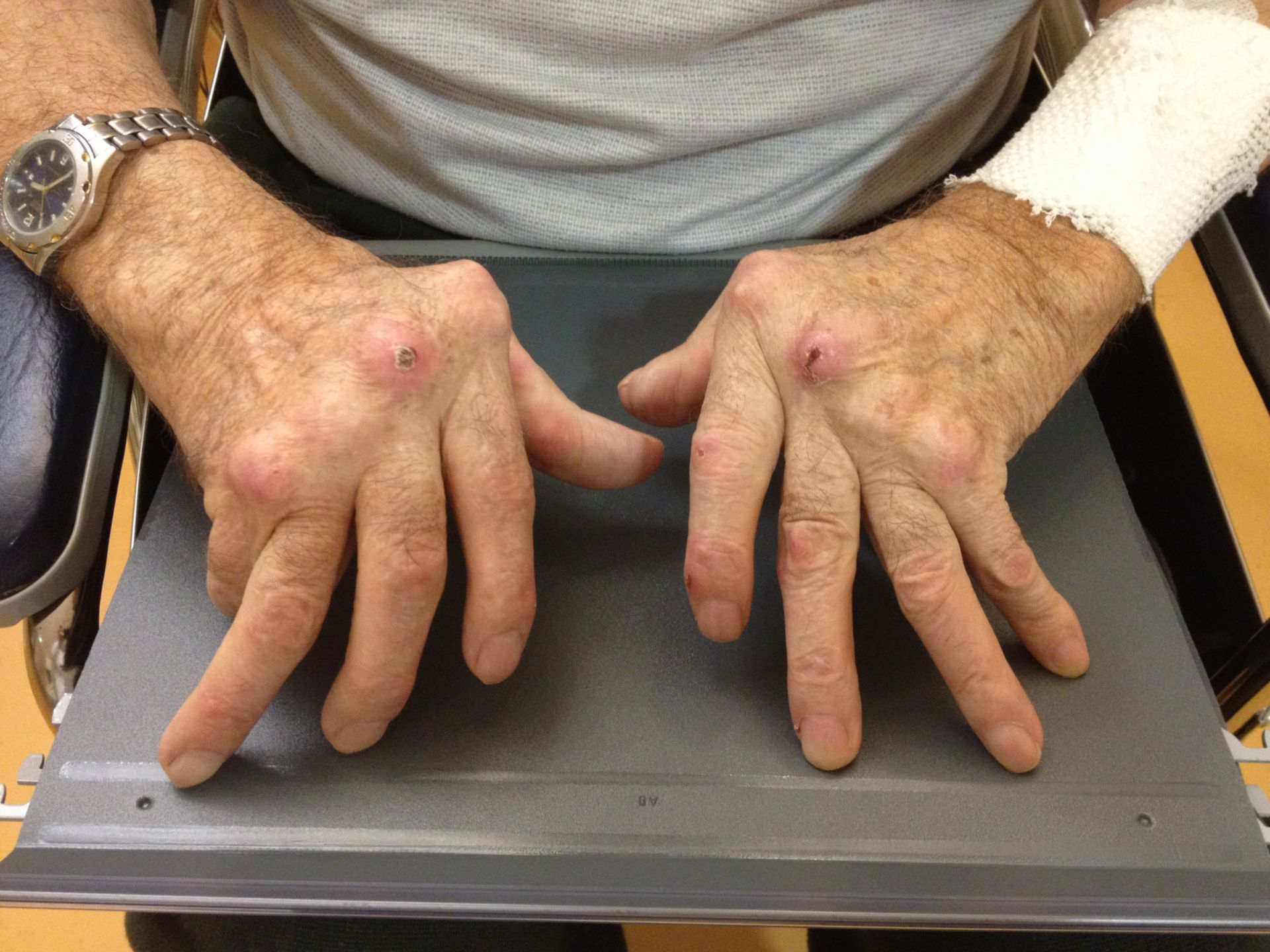 Cambios en las articulaciones en la artritis reumatoide