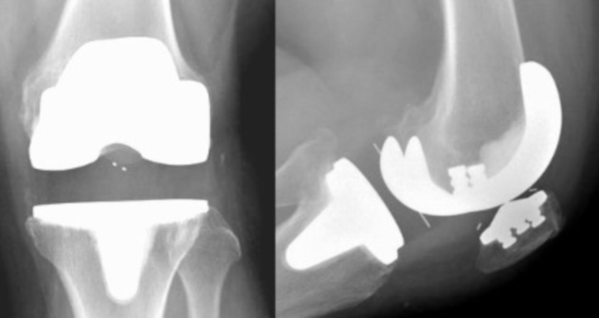 Röntgenbild einer Knie-Totalendoprothese