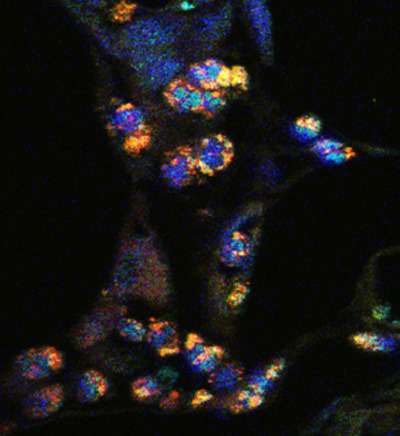 Immunzellen (T-Zellen) im Bauchspeicheldrüsenkrebs, die ihre Entzündungsstoffe (Zytokine) über den alternativen p38-Signalweg bilden und dadurch das Tumorwachstum fördern. © Pathologisches Institut, Universitätsklinikum Heidelberg