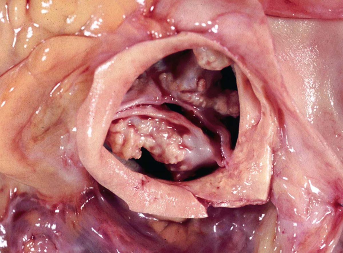 Aorteklappenstenose bei verkalkter Bikuspidalklappe